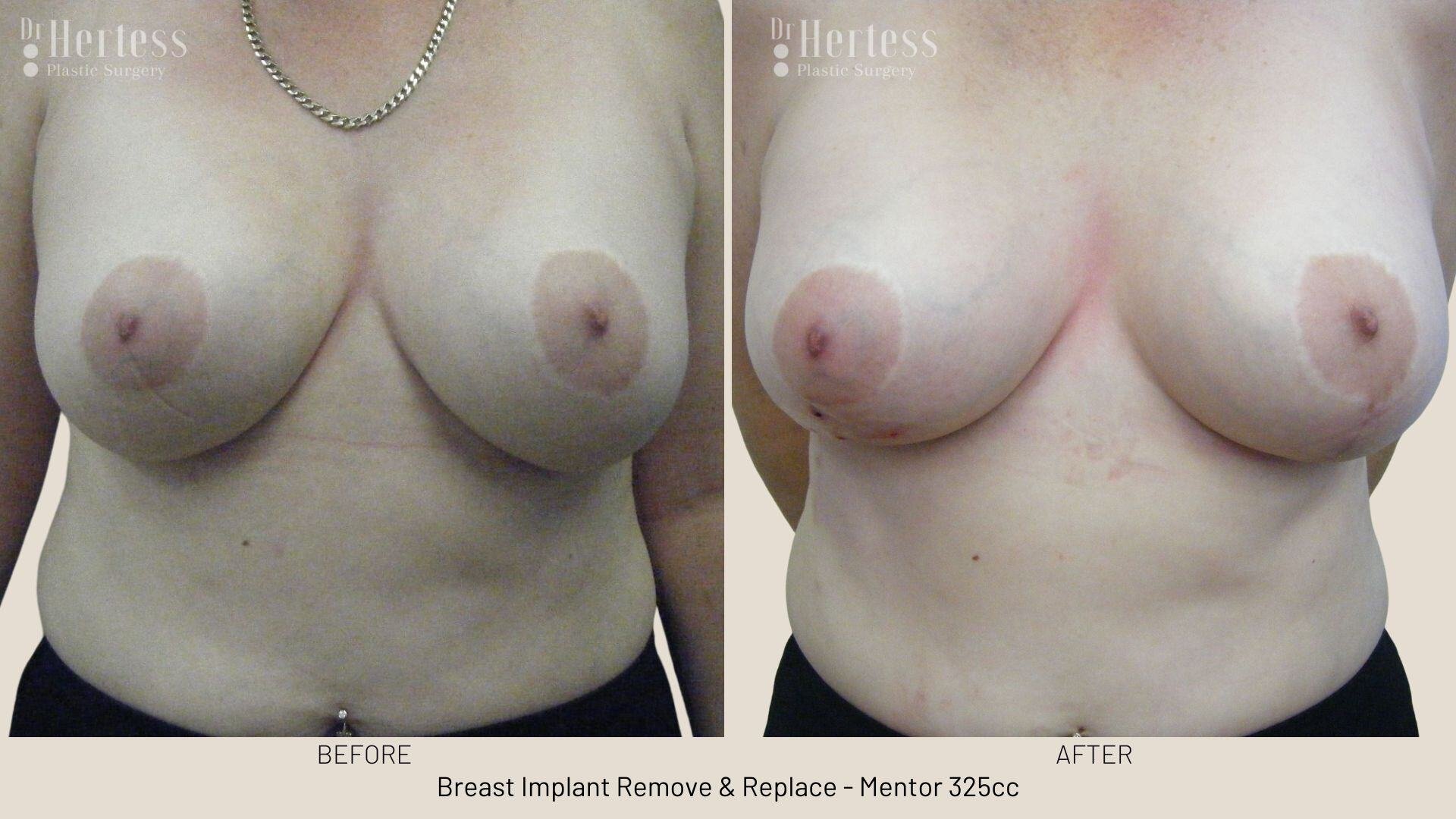 remove replace breast implants photos