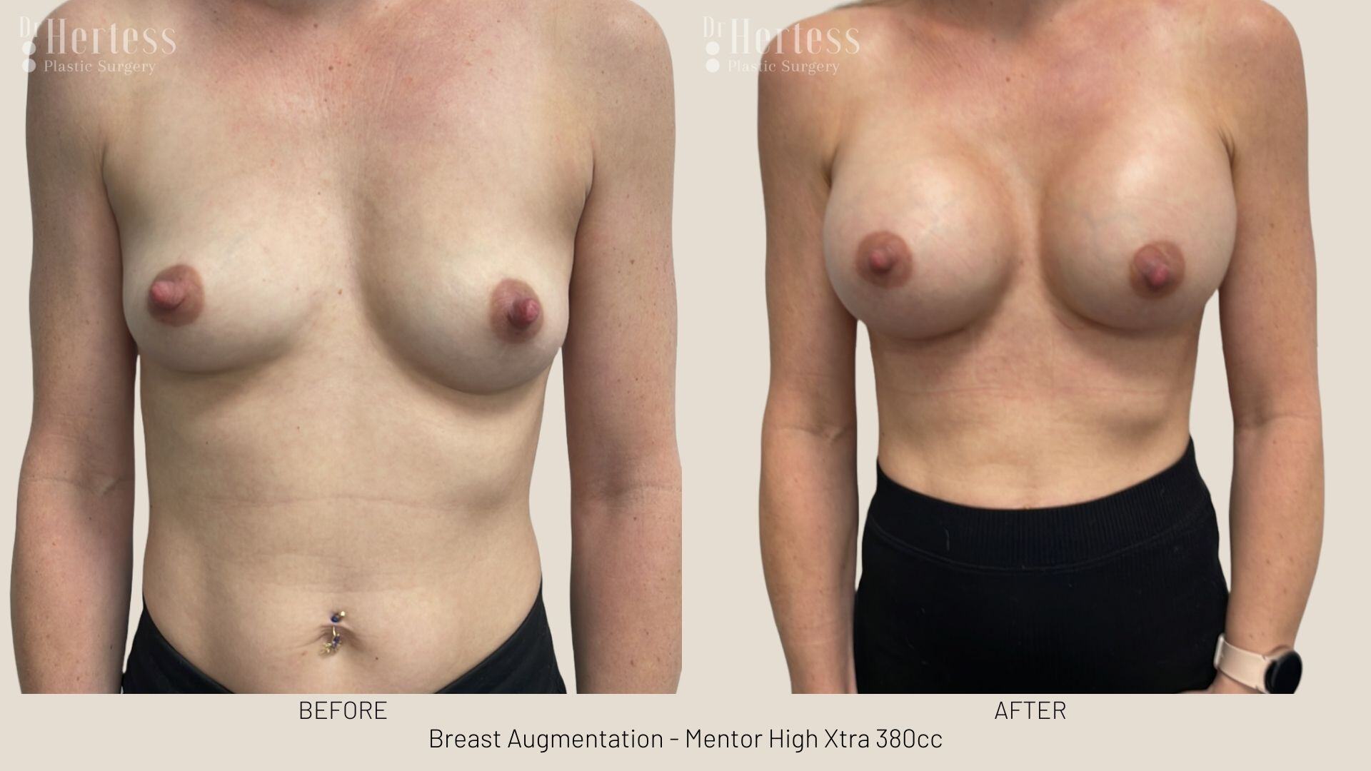 breast implant photos before and after