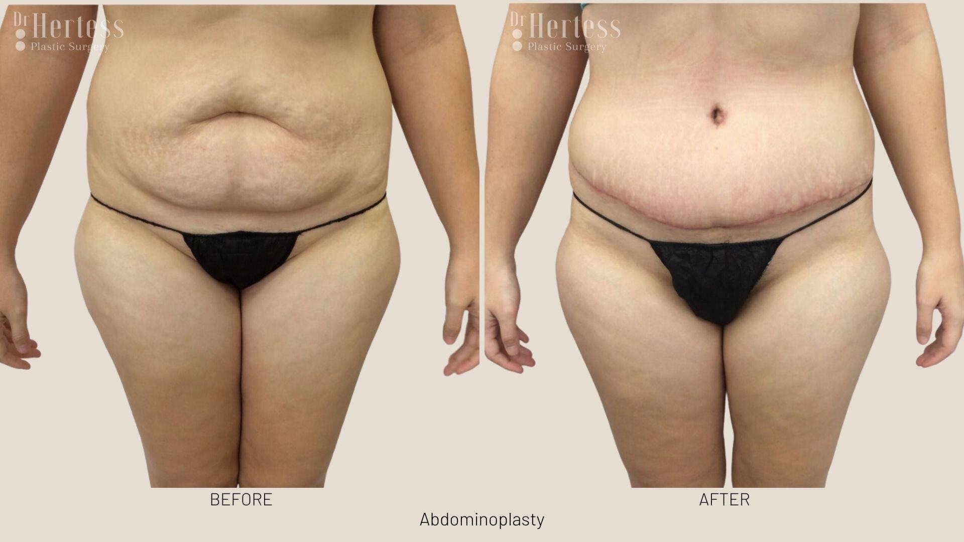 tummy tuck before and after