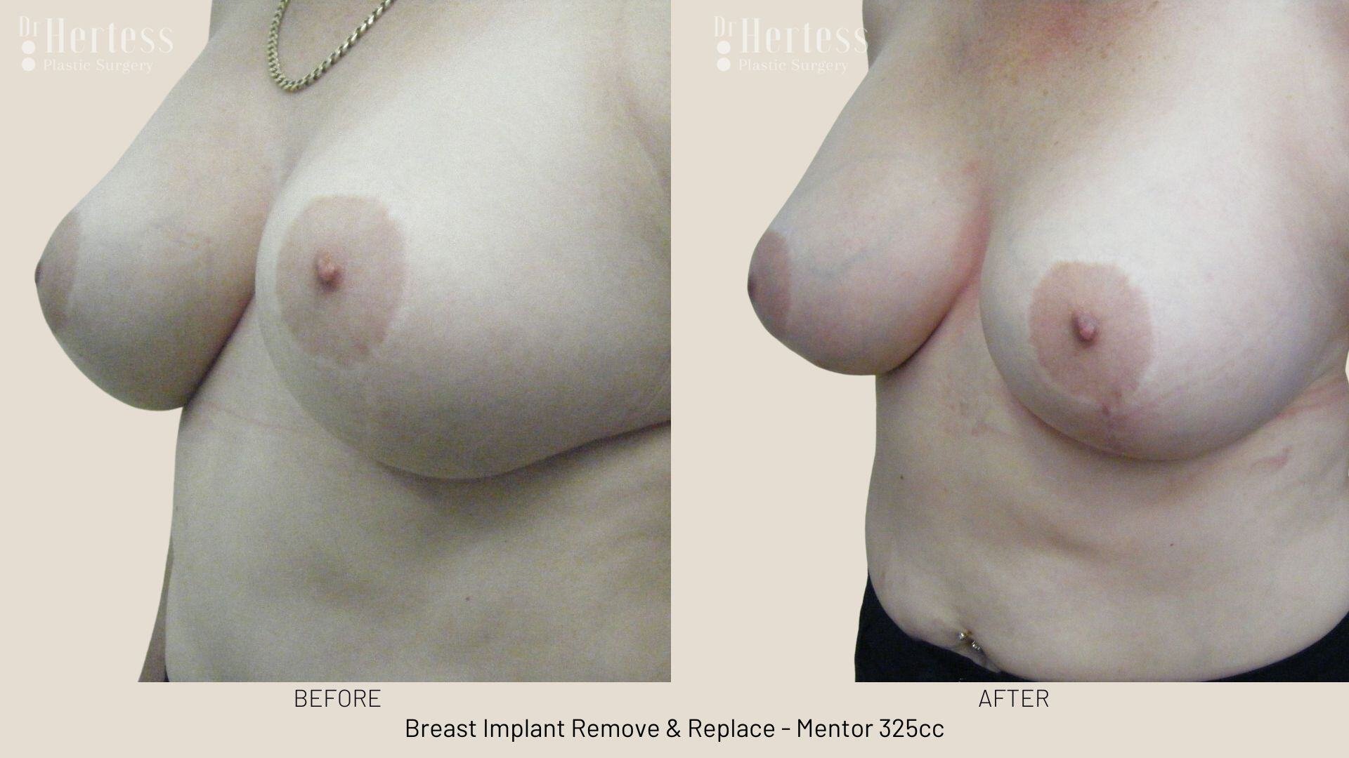 remove replace breast implants photos