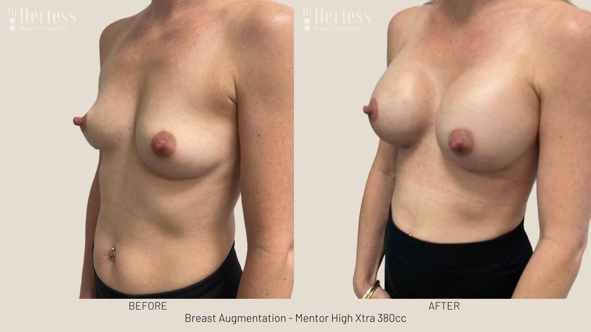 breast implant photos before and after