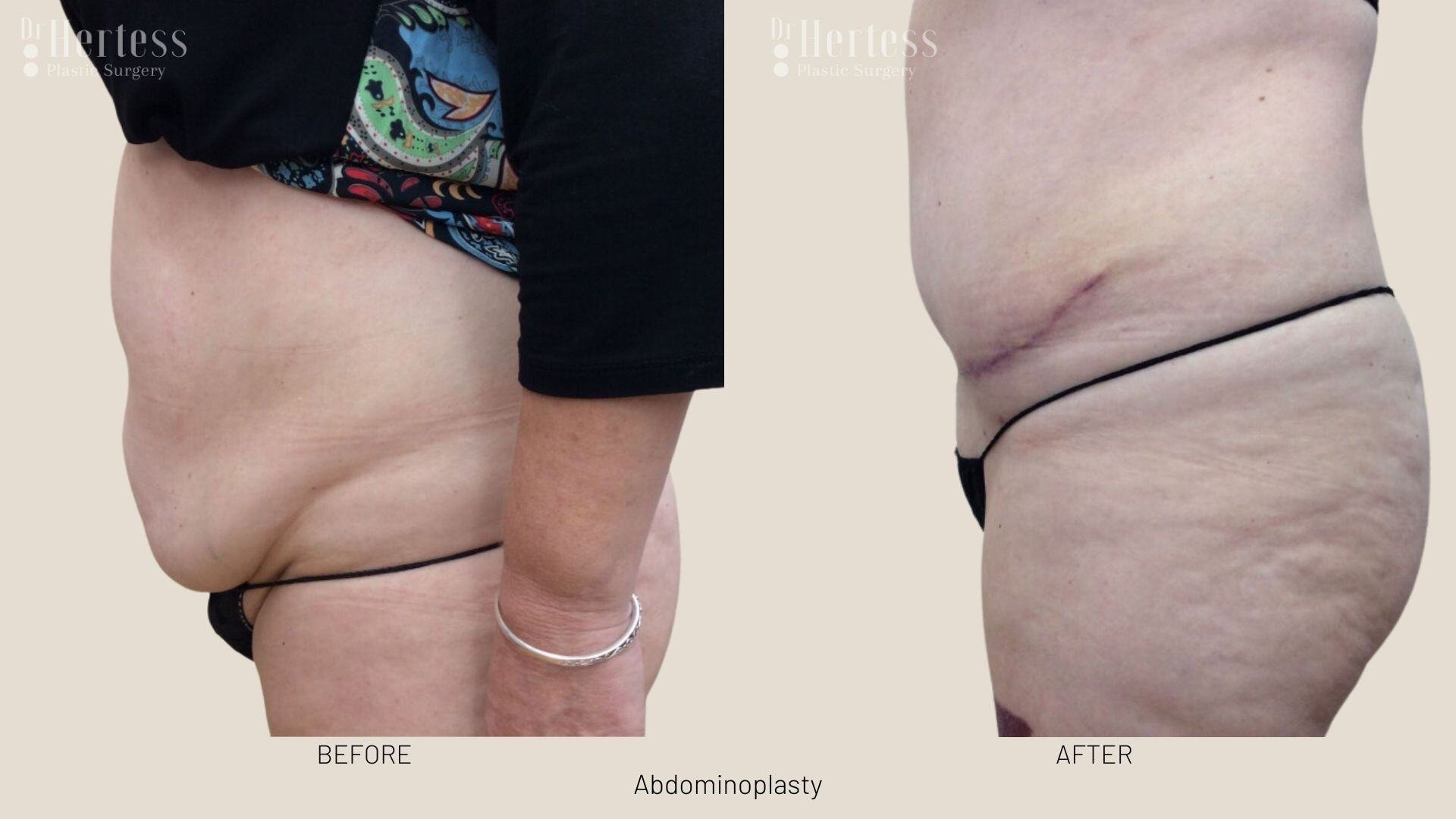 tummy tuck before and after