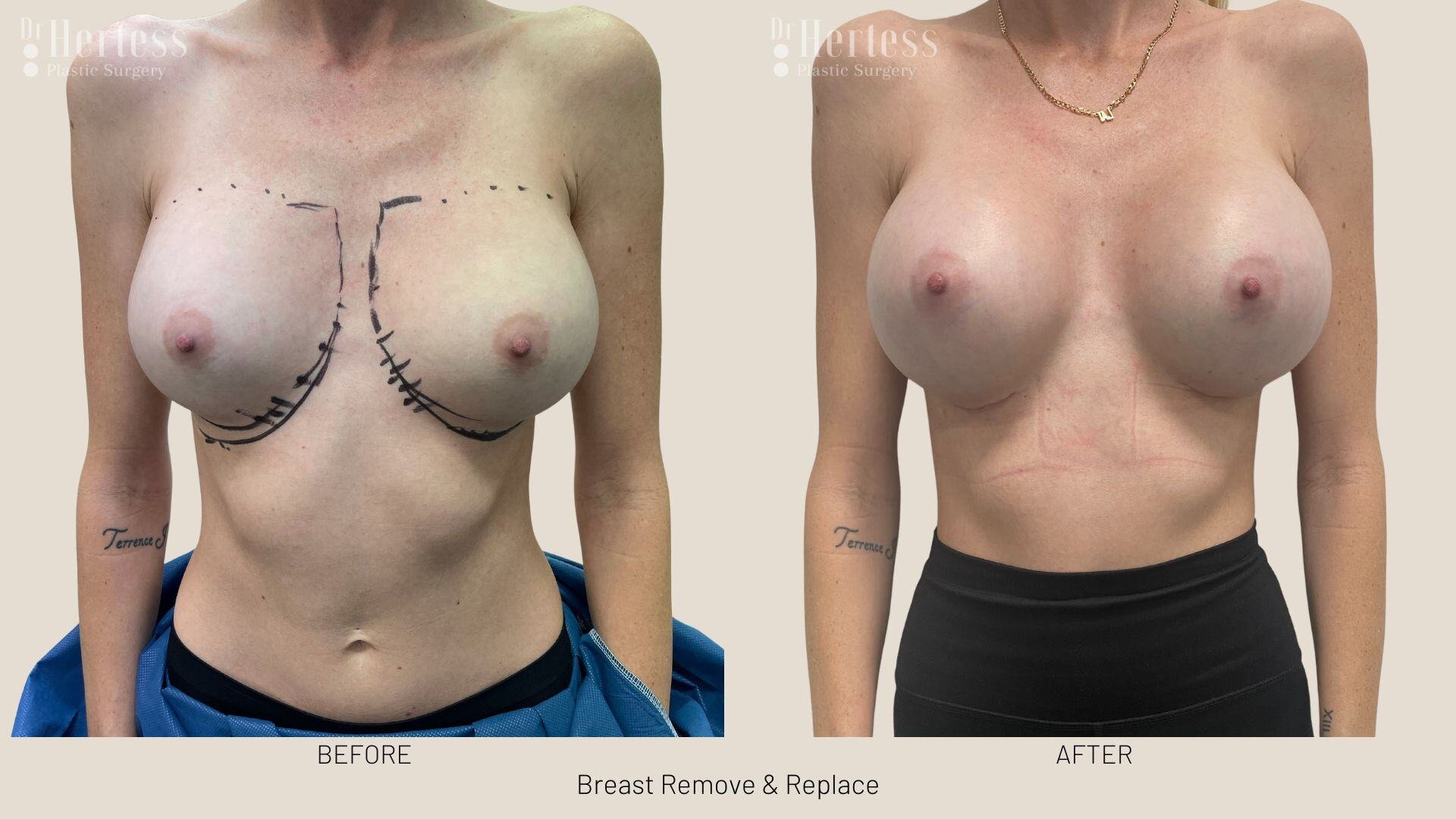 remove replace breast implants photos
