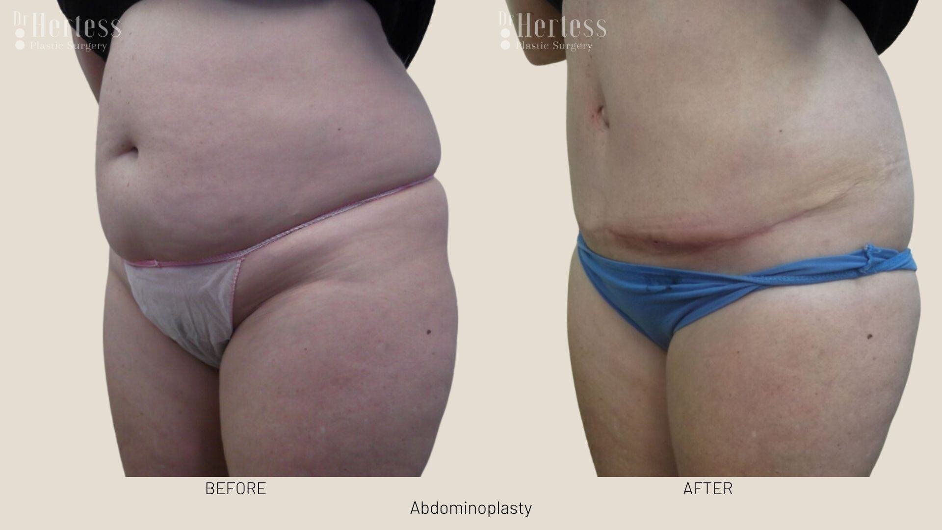 tummy tuck before and after
