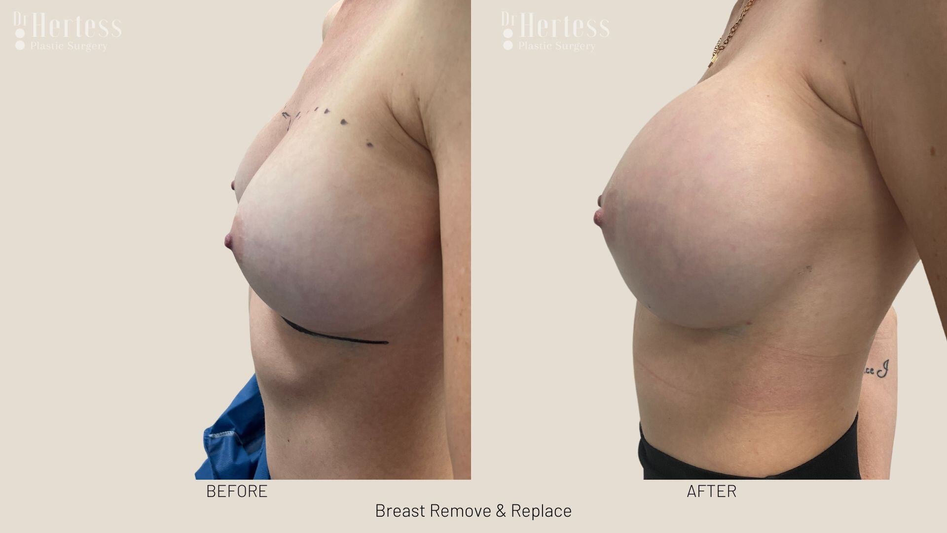 remove replace breast implants photos