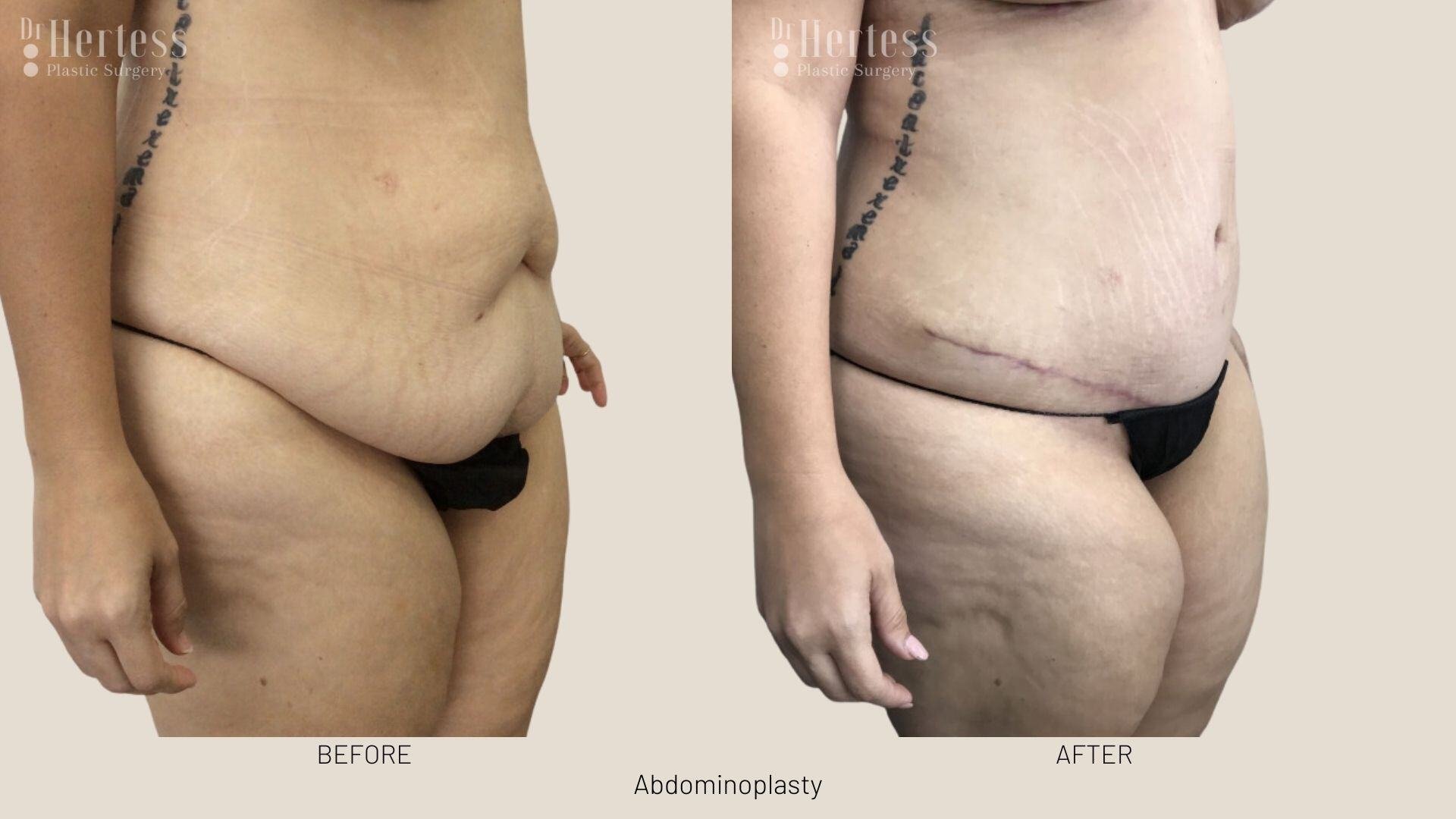 tummy tuck before and after
