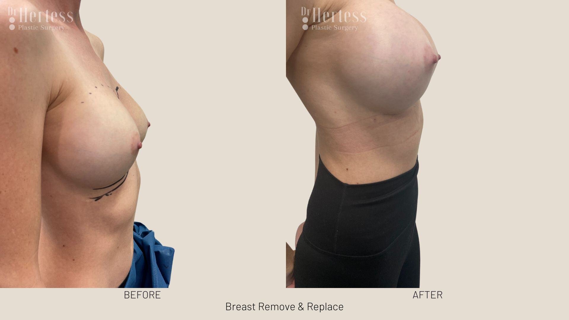 remove replace breast implants photos