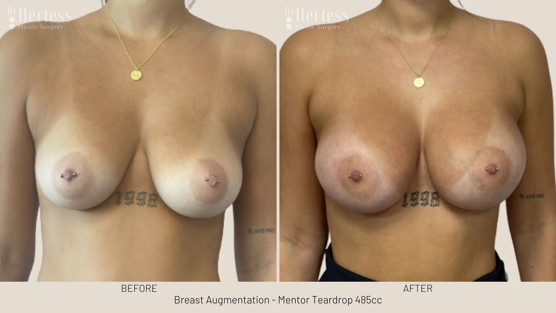breast implant photos before and after