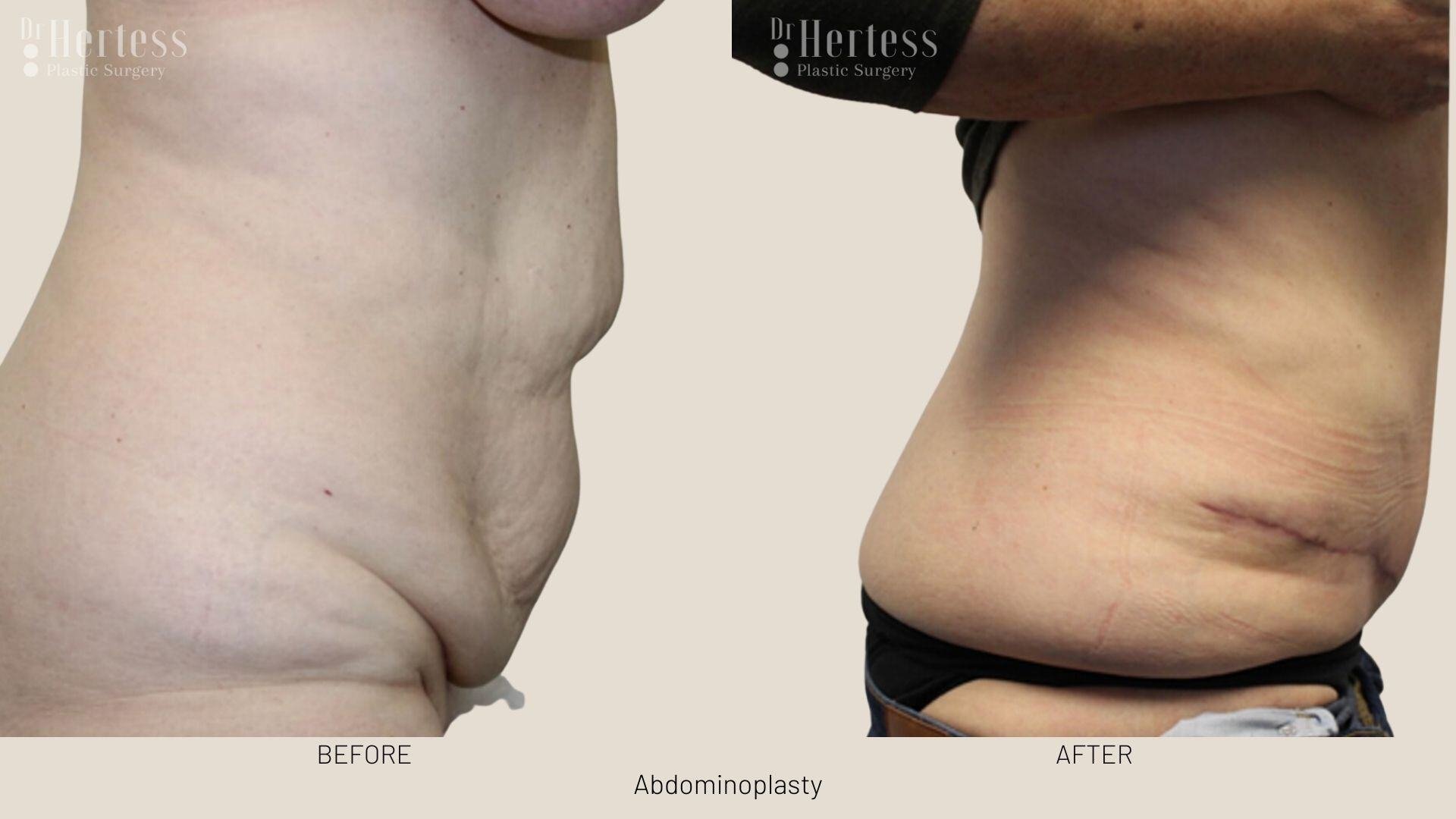 tummy tuck before and after