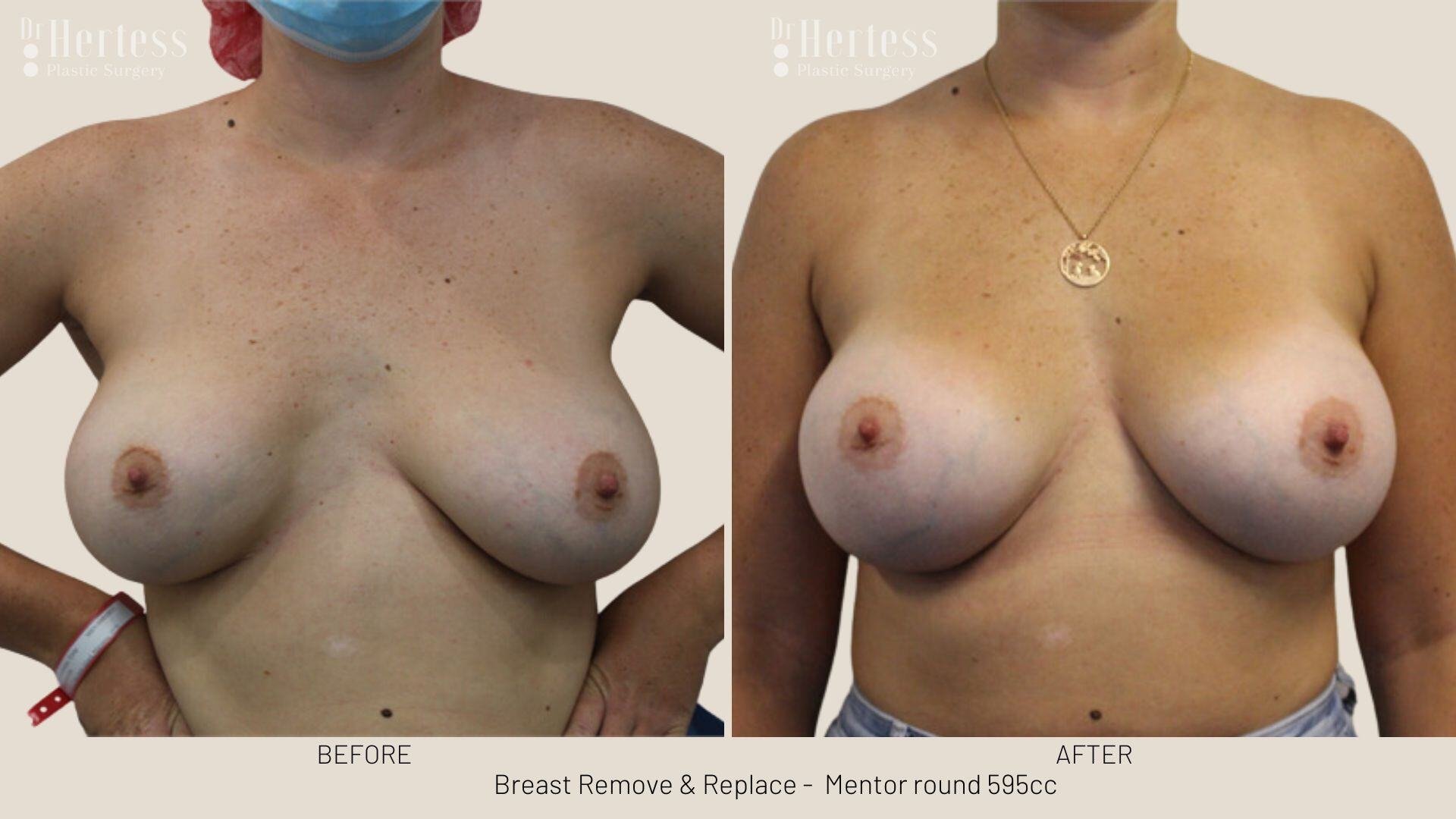 remove replace breast implants photos