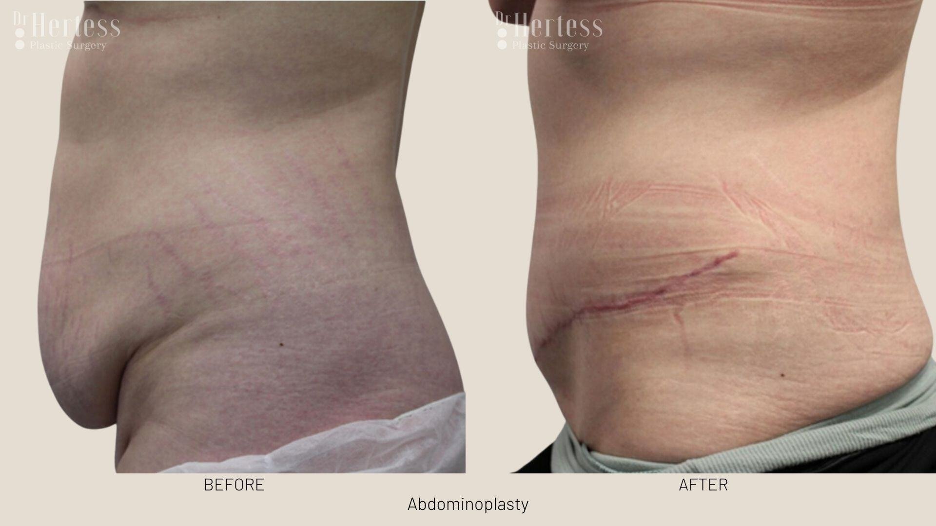 tummy tuck before and after