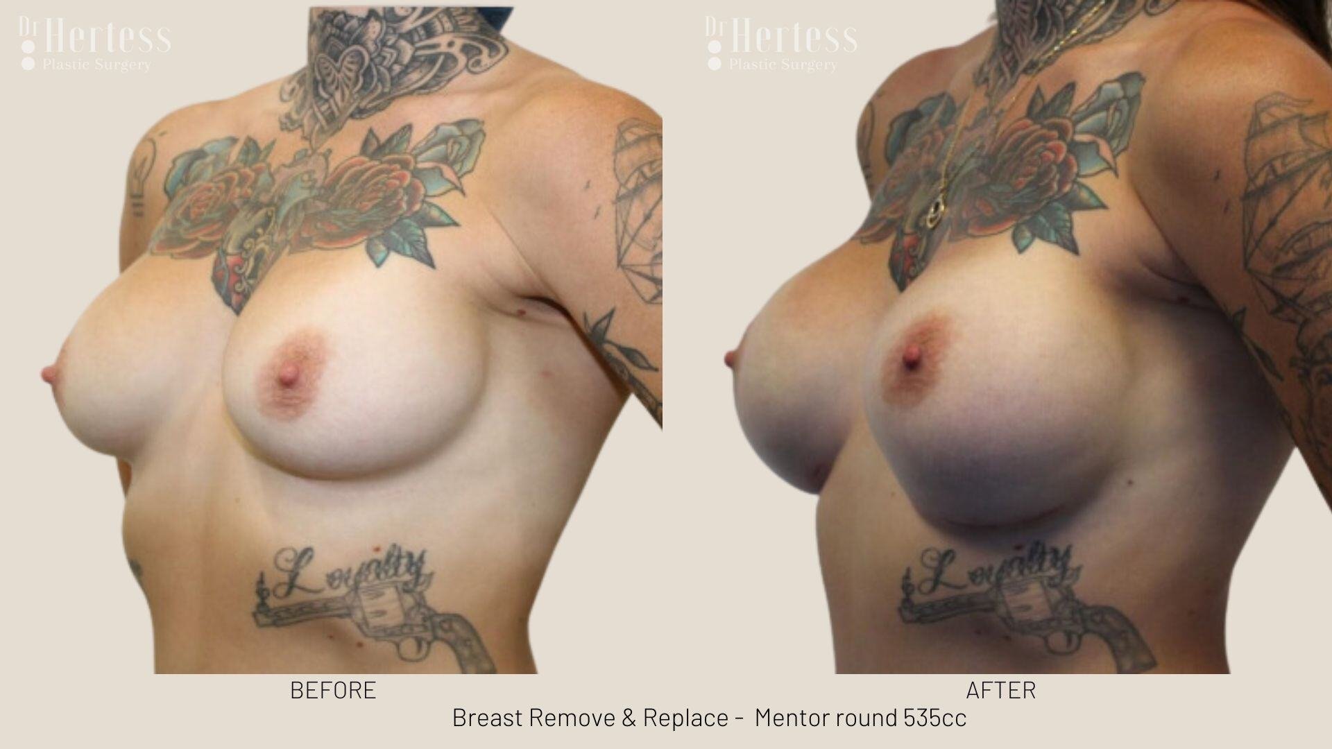 remove replace breast implants photos