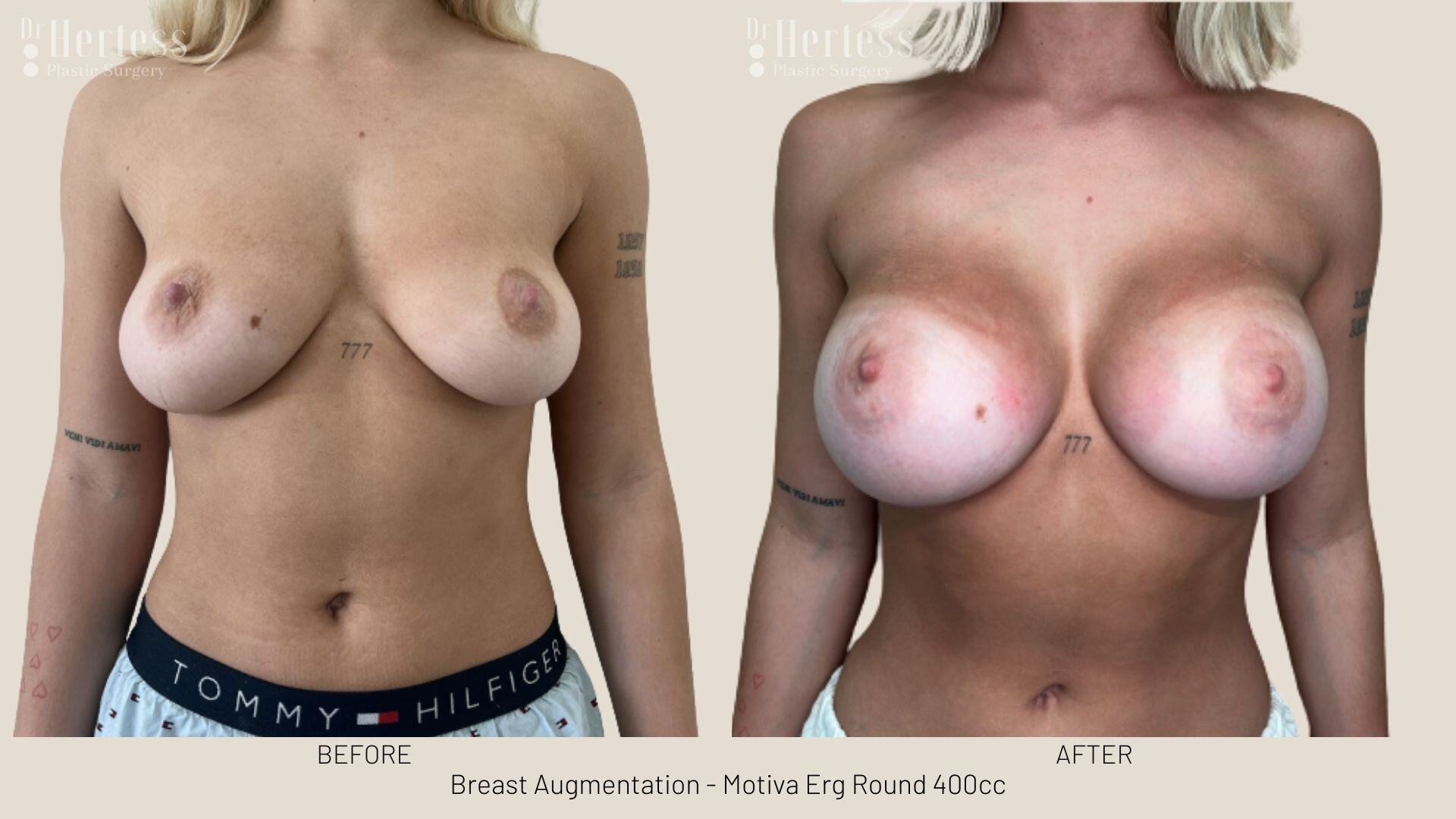 breast implant photos before and after