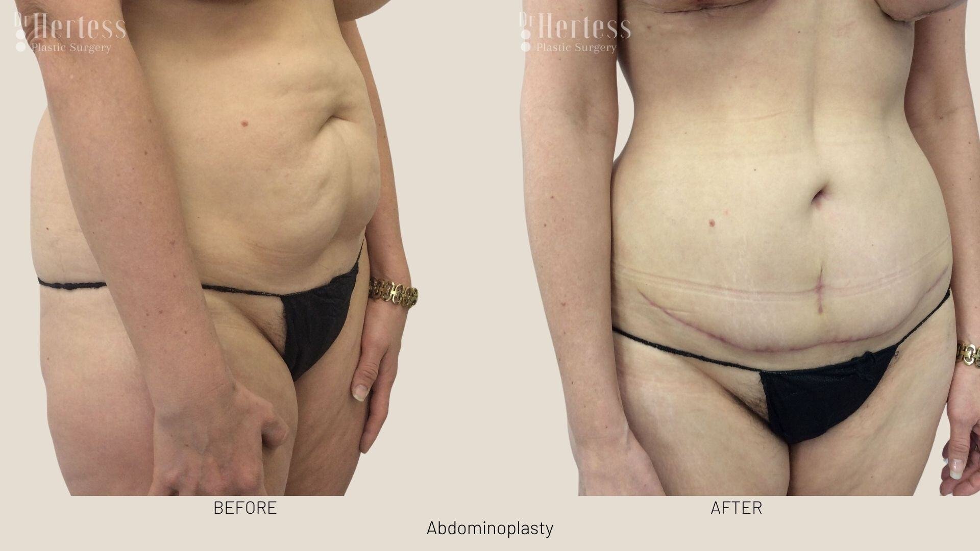 tummy tuck before and after