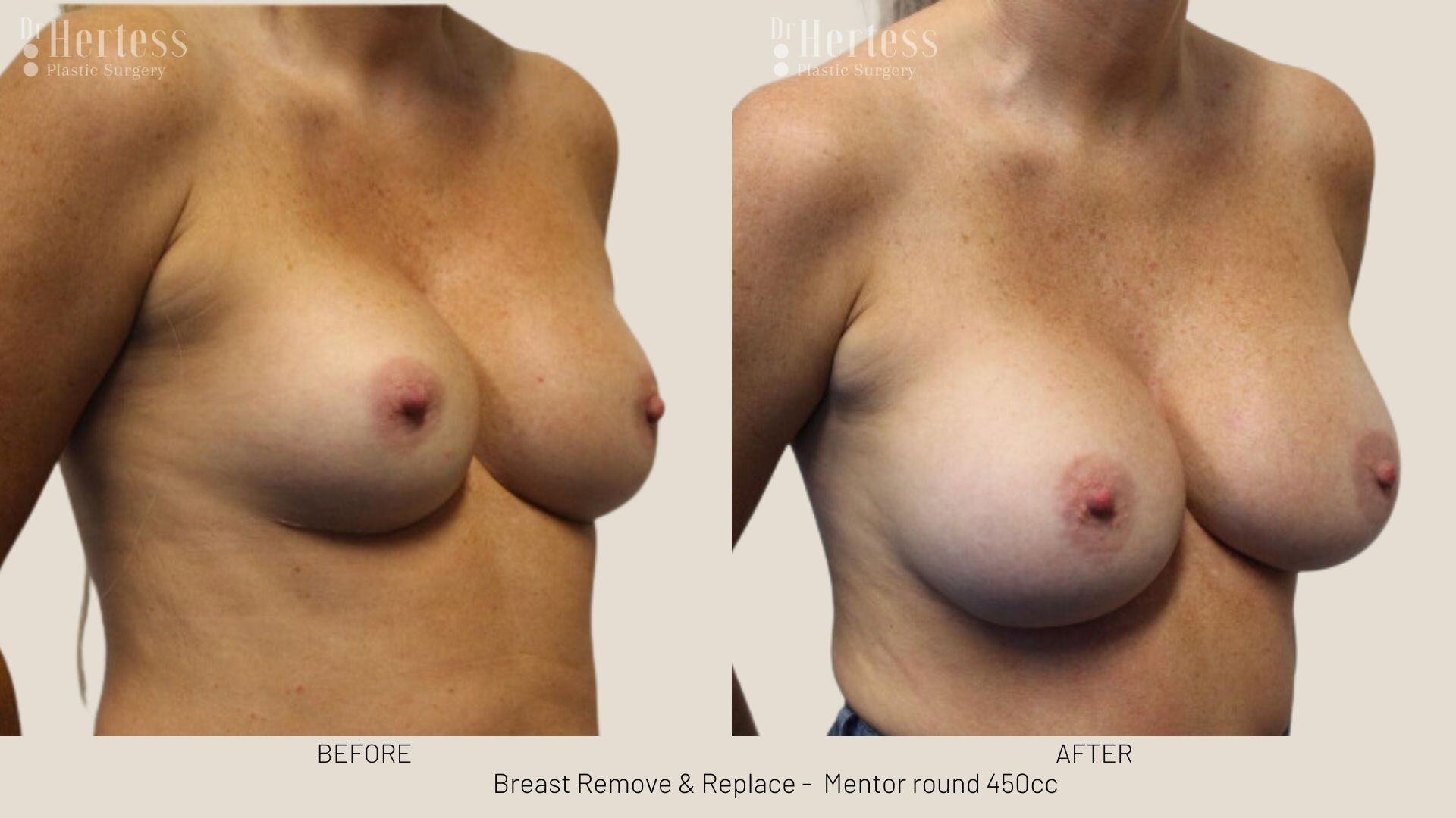 remove replace breast implants photos