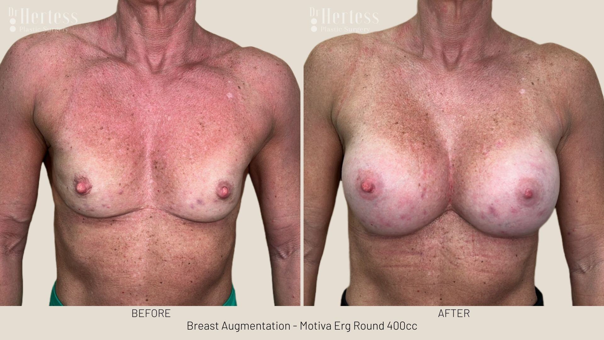 breast implant photos before and after