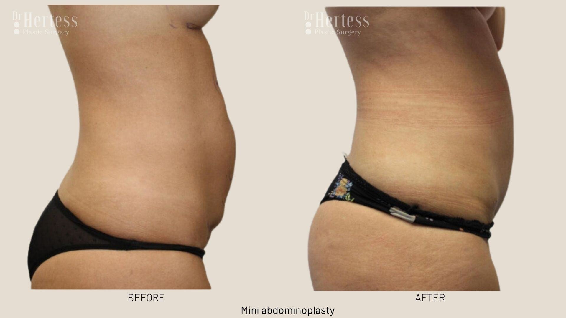 tummy tuck before and after