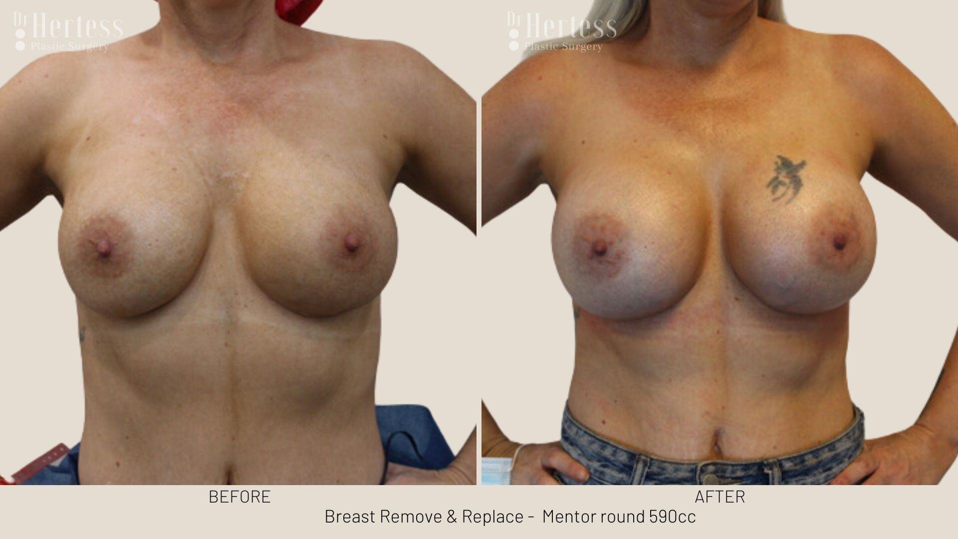 remove replace breast implants photos