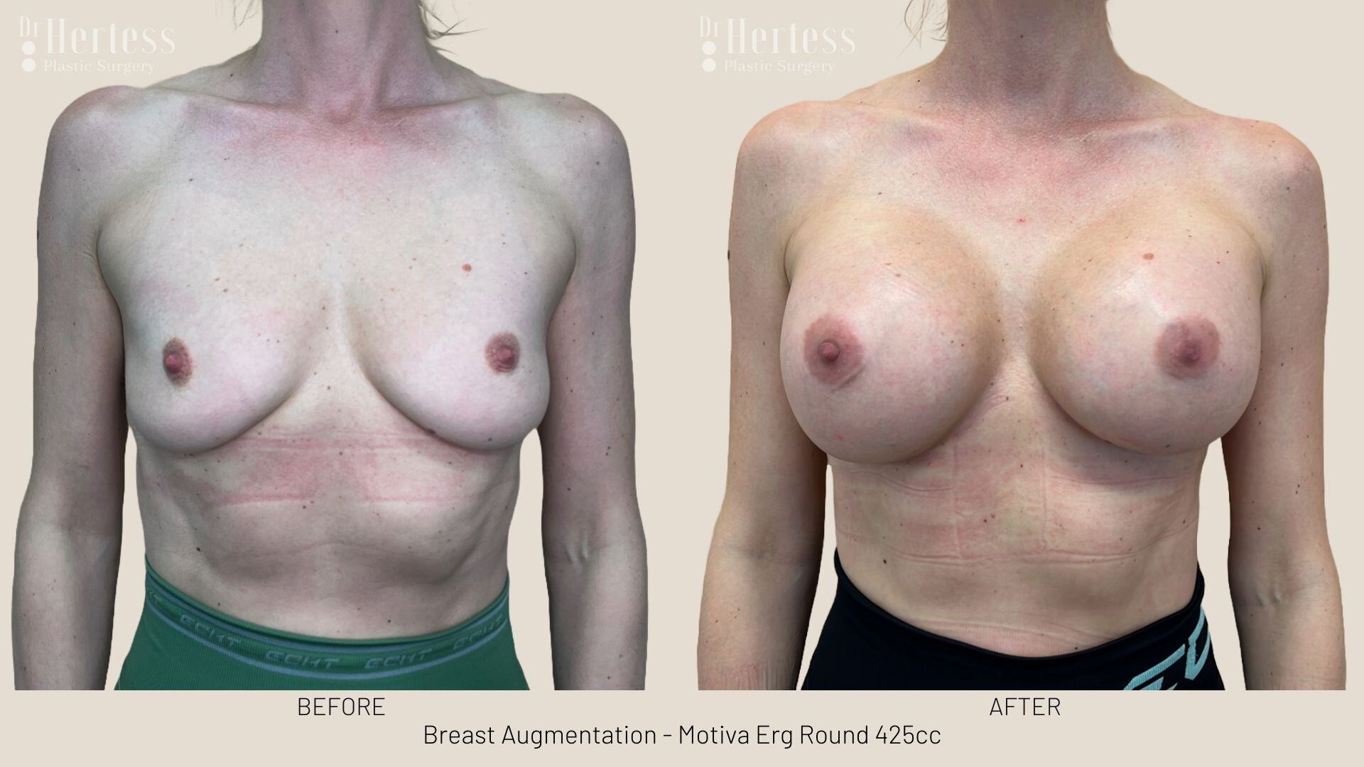 breast implant photos before and after