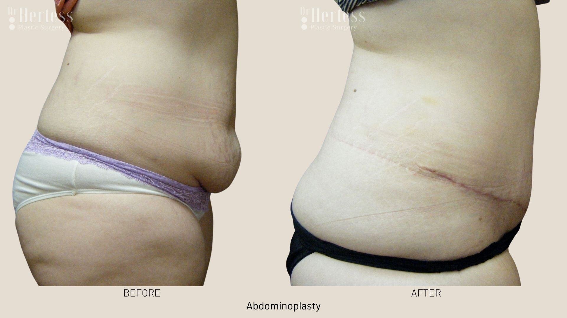 tummy tuck before and after