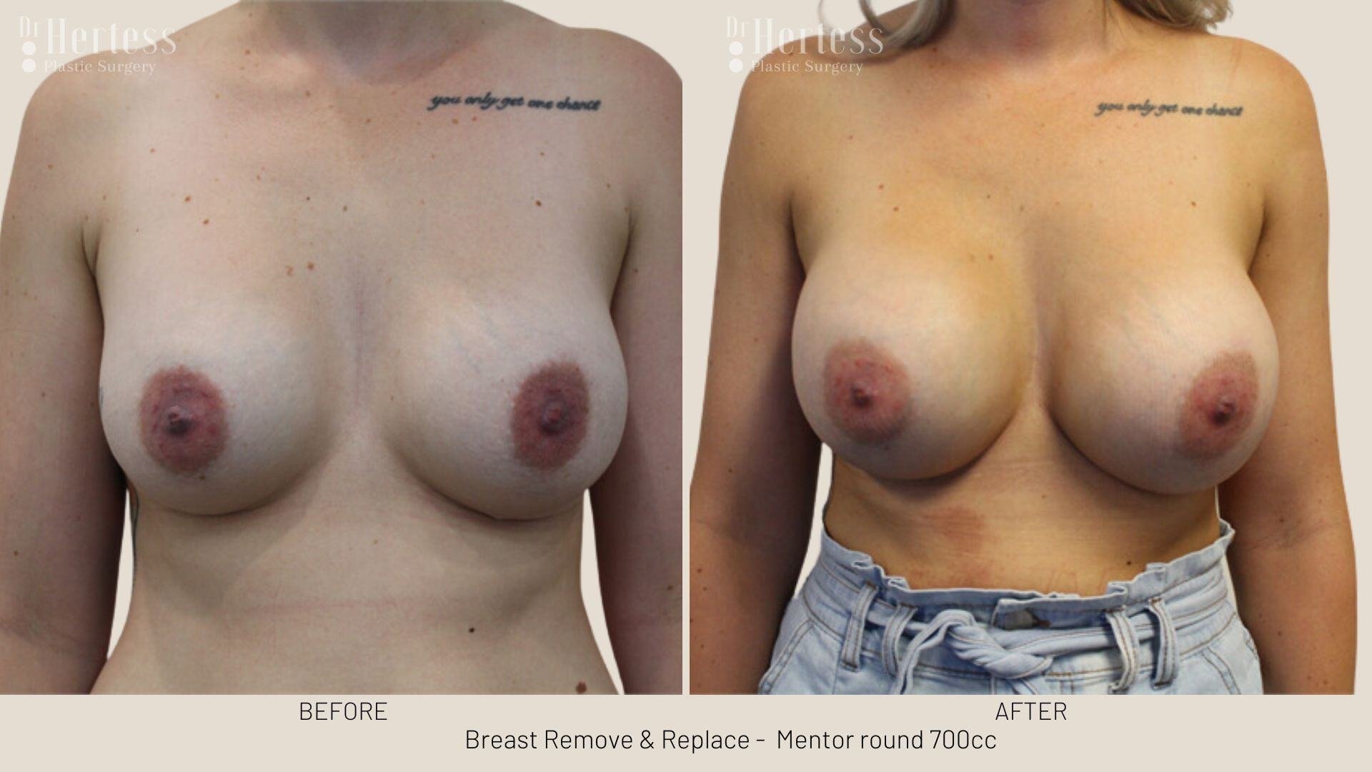 remove replace breast implants photos