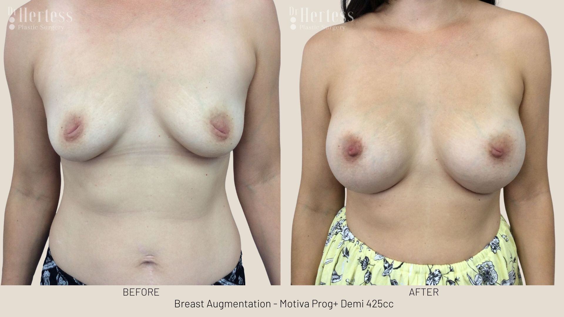 breast implant photos before and after