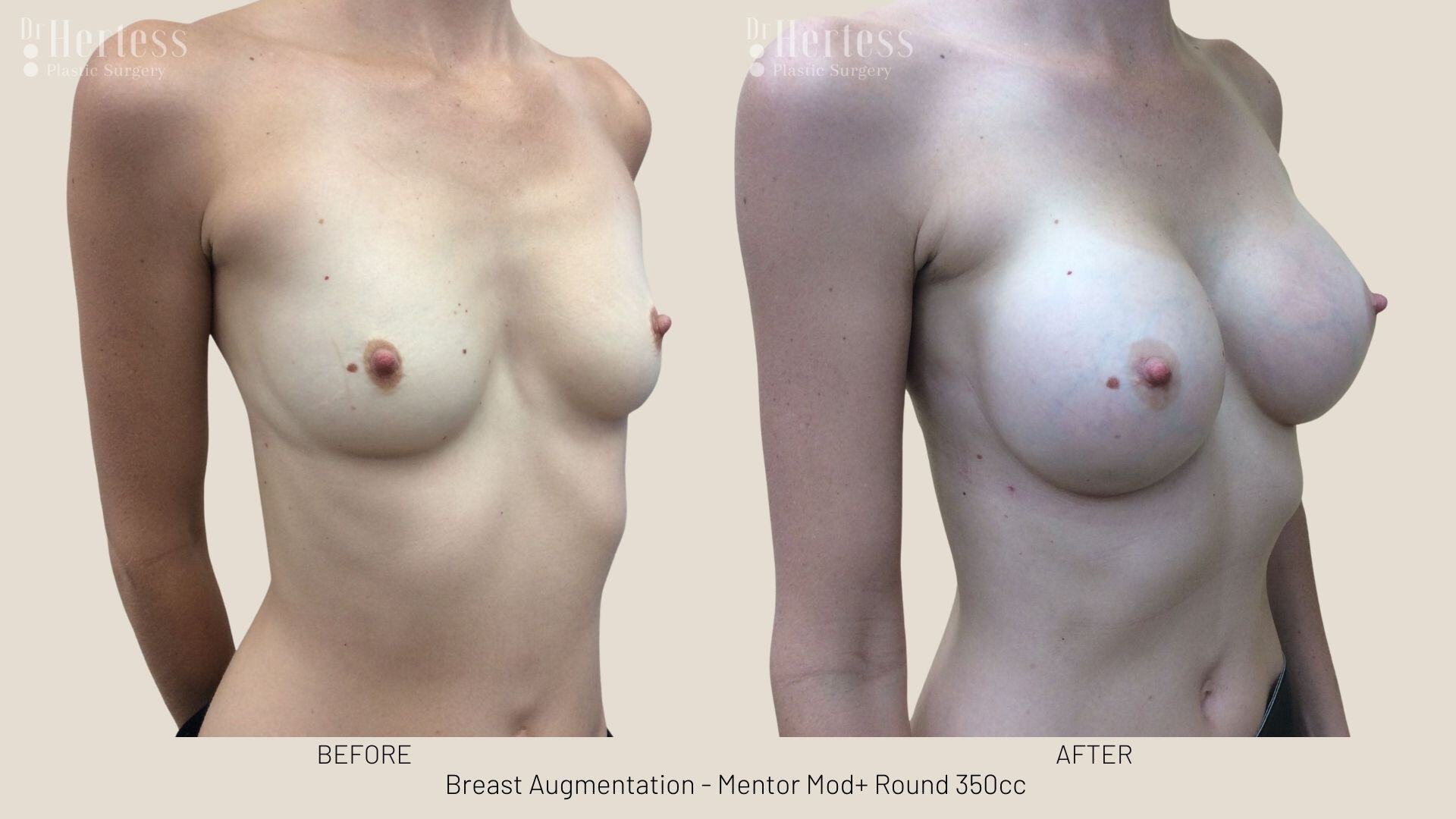 breast implants before and after