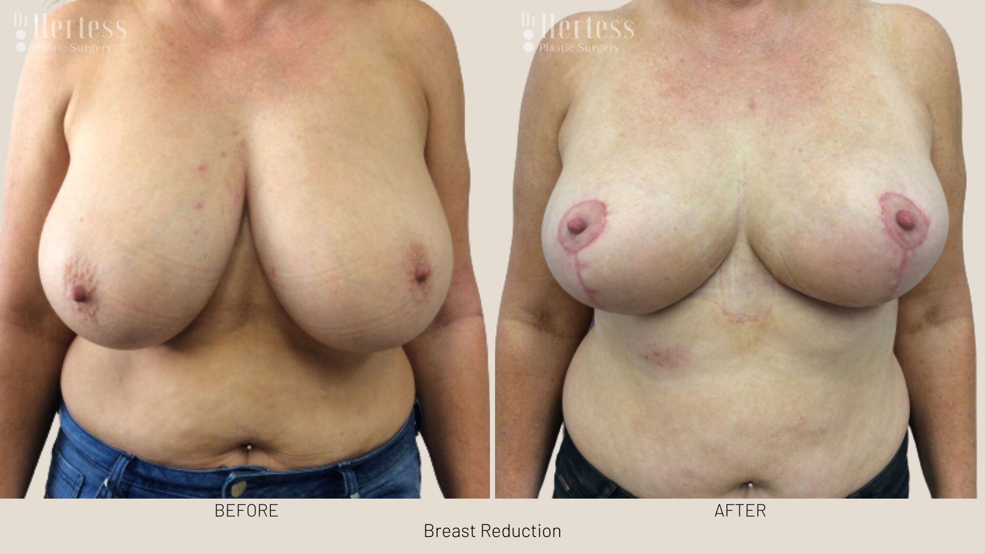 breast reduction before and after