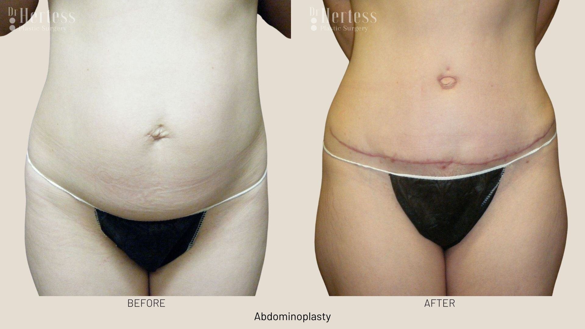 abdominoplasty before and after photos