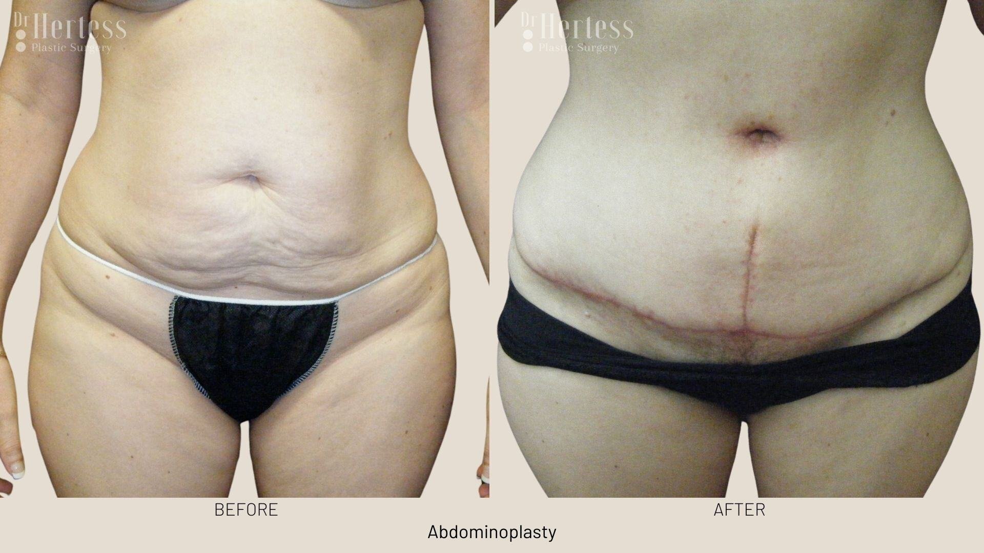tummy tuck before and after