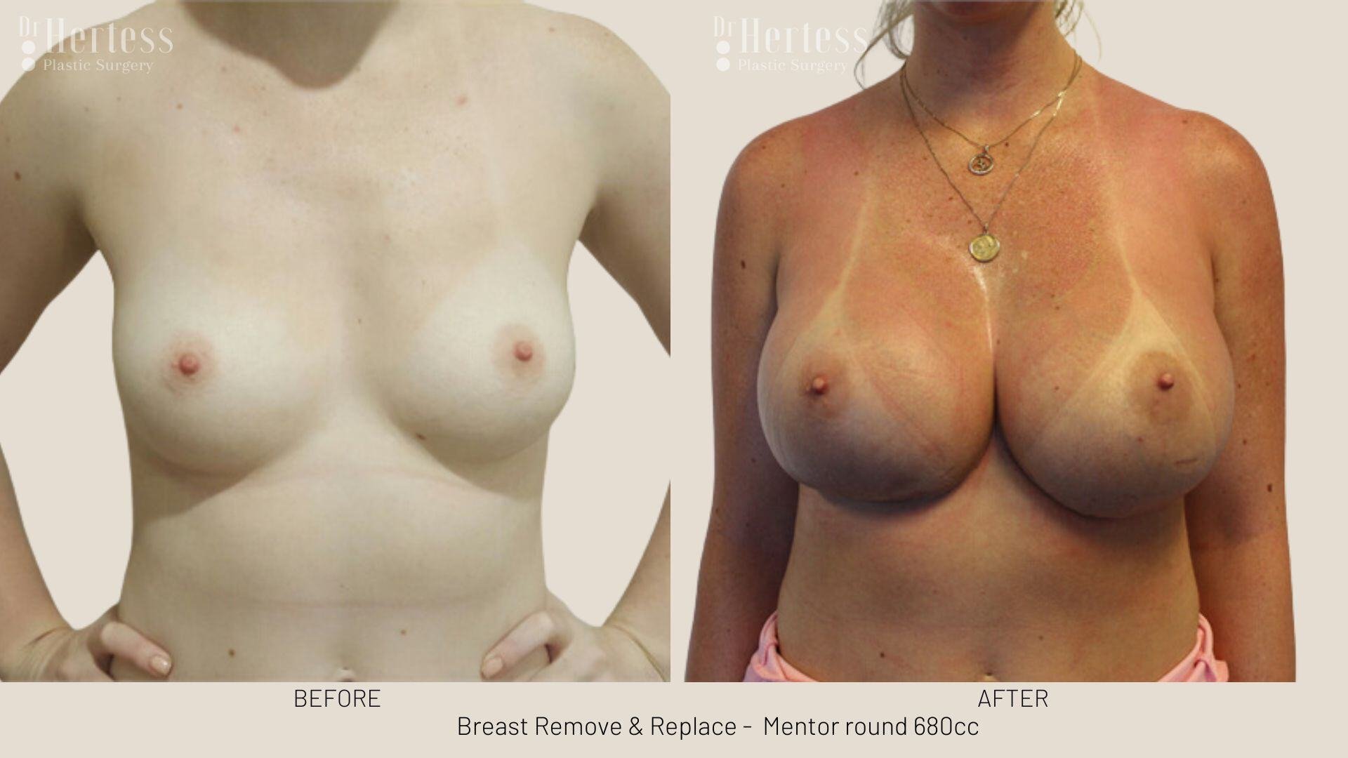 remove replace breast implants photos