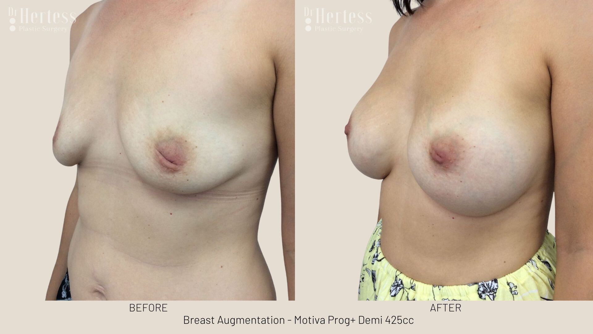 breast implant photos before and after