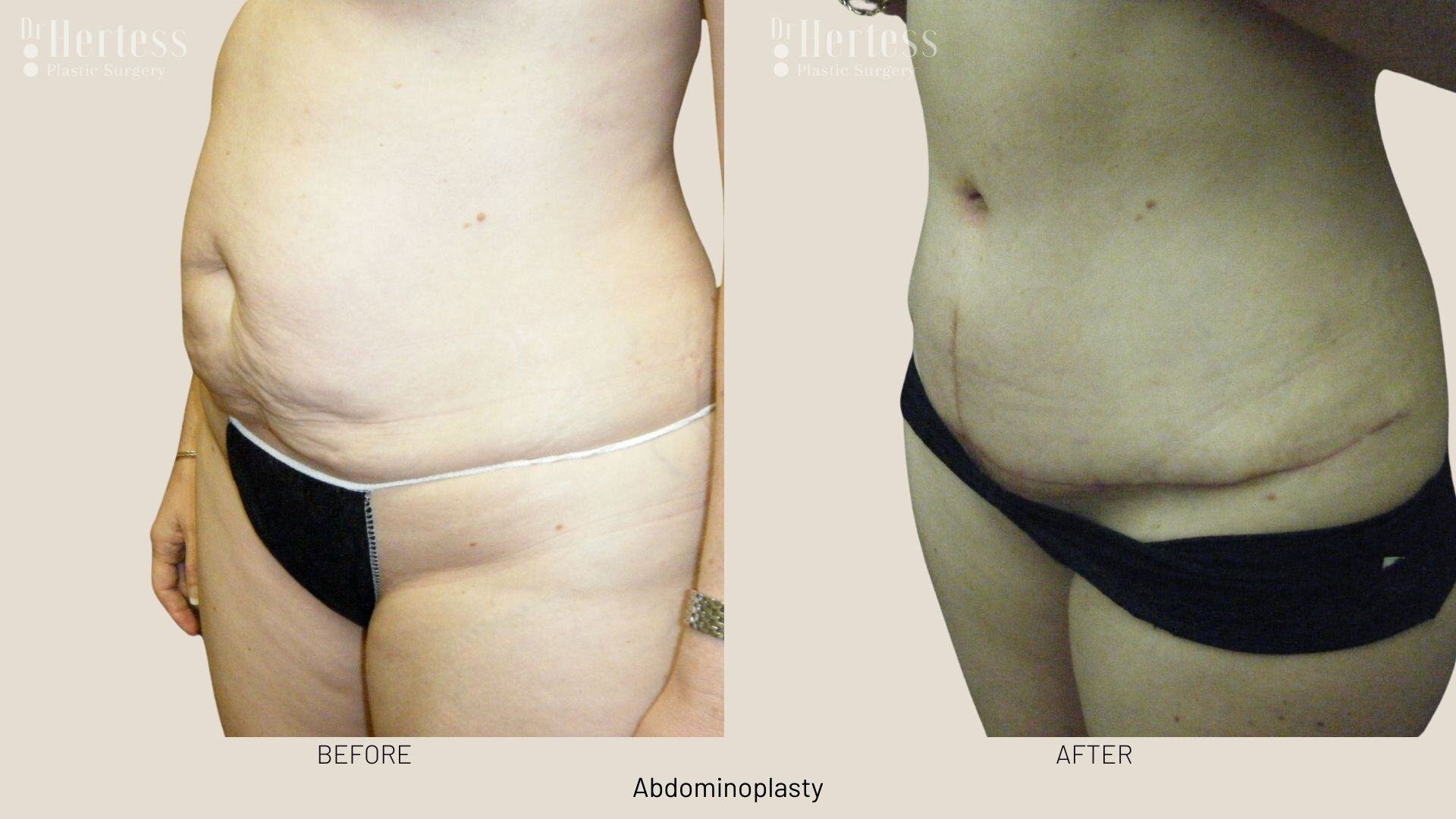 tummy tuck before and after