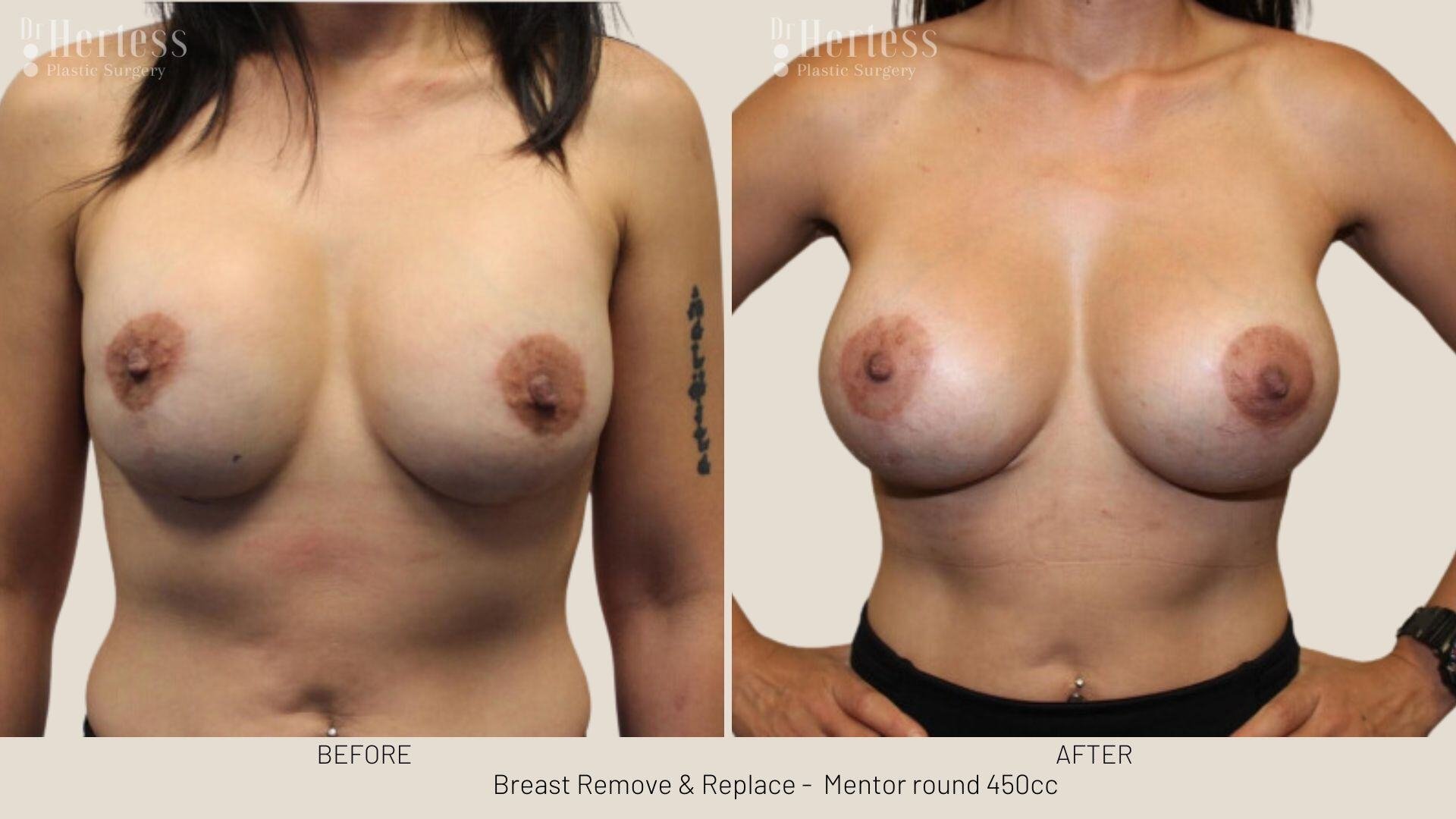 remove replace breast implants photos