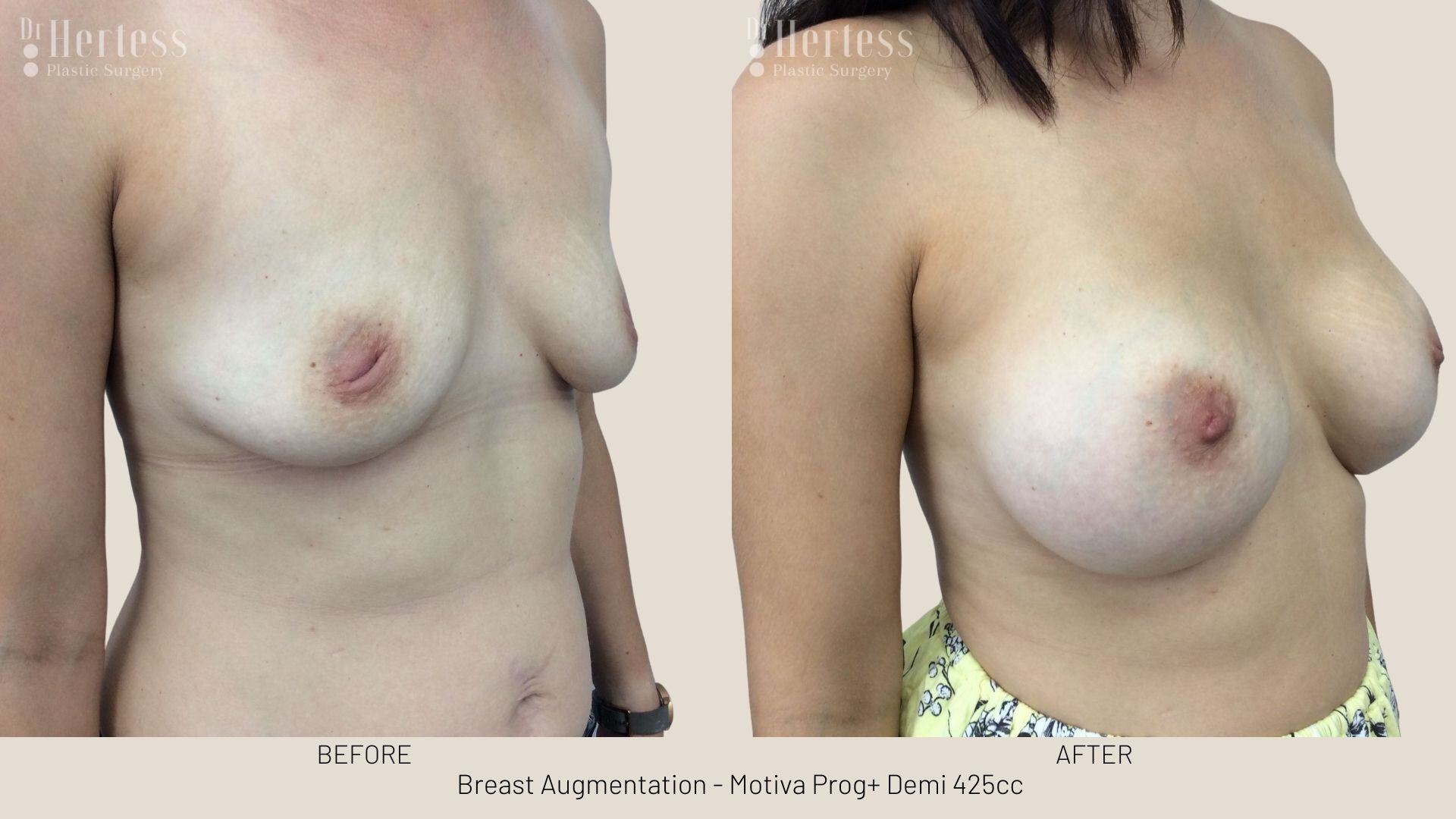 breast implant photos before and after