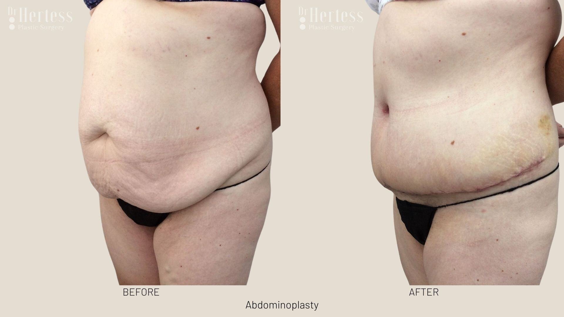 tummy tuck before and after