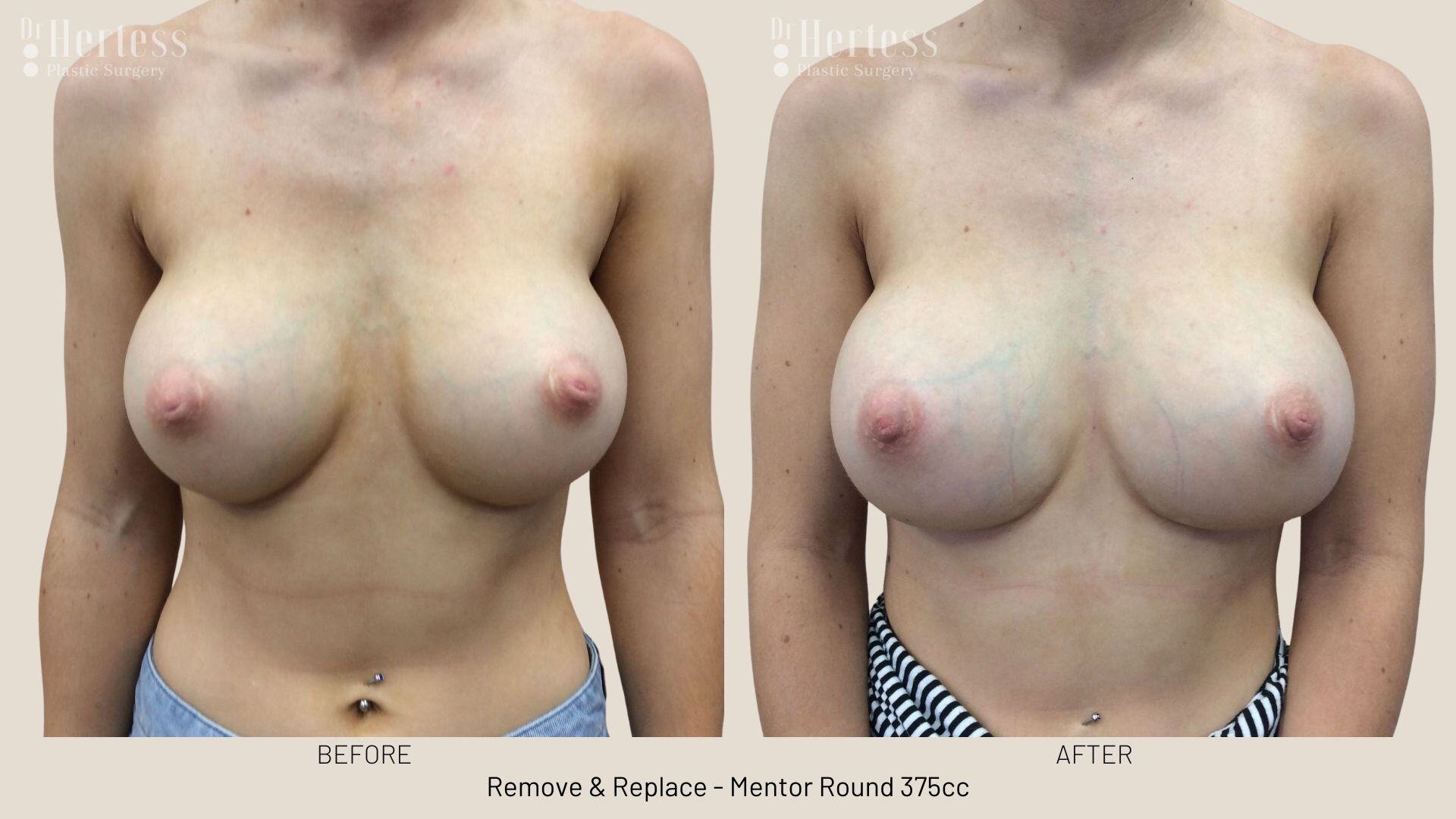 remove replace breast implants photos