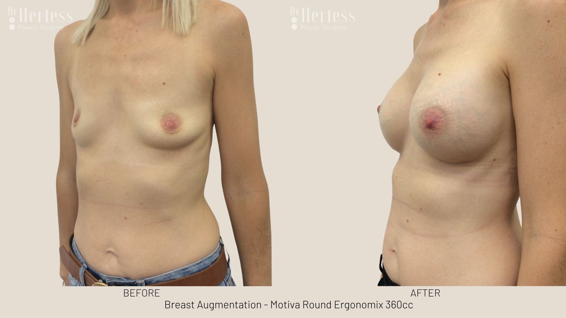 breast implant photos before and after