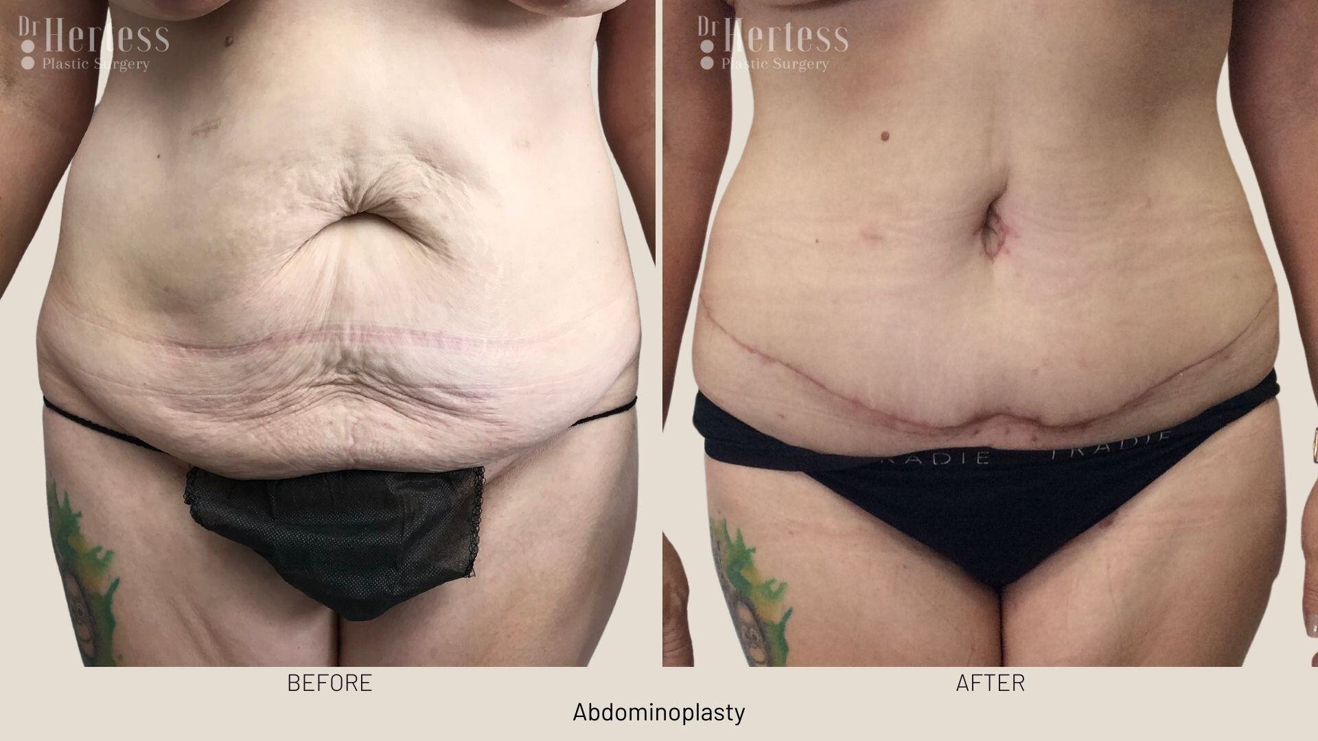 tummy tuck before and after
