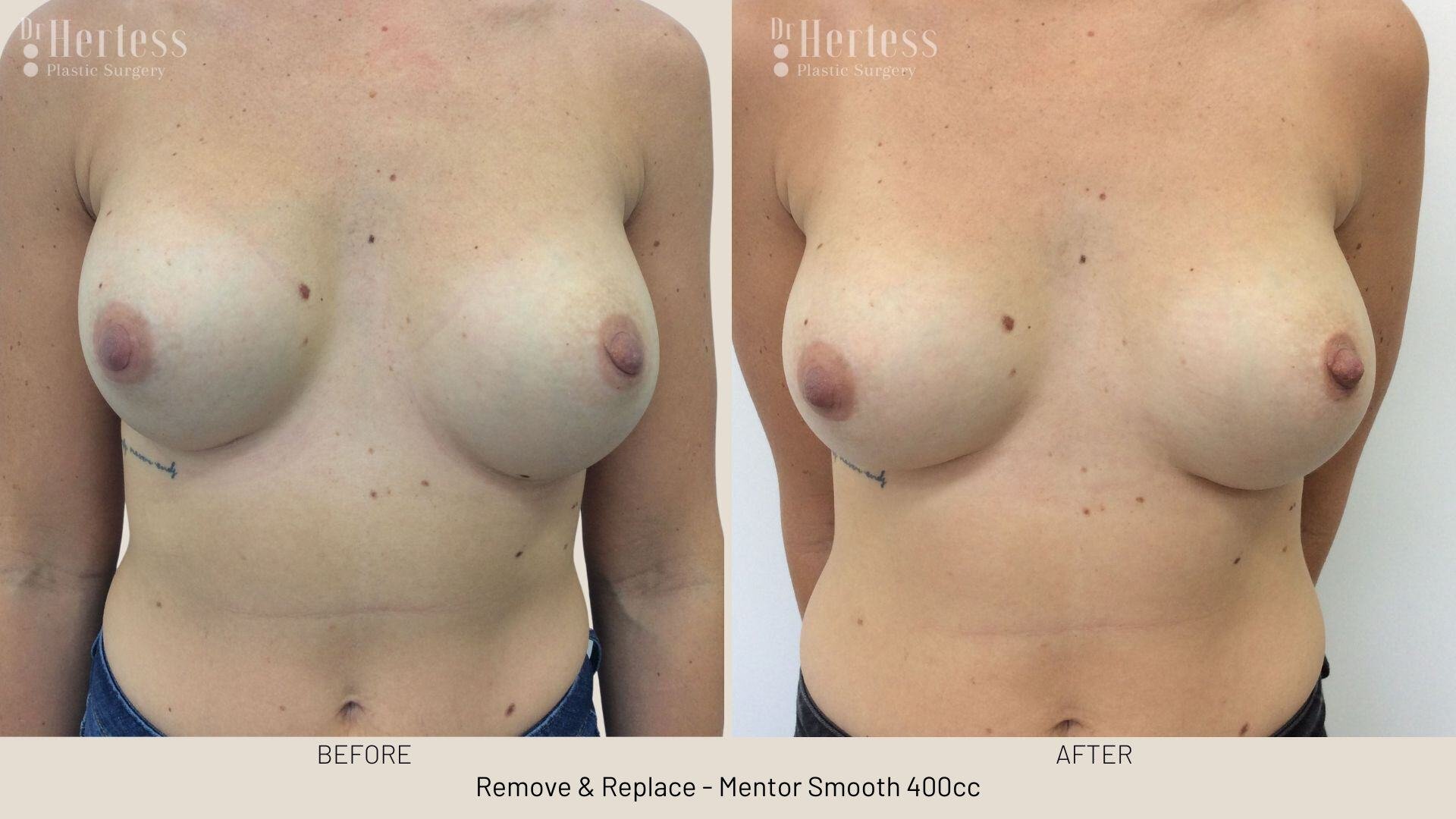 remove replace breast implants photos