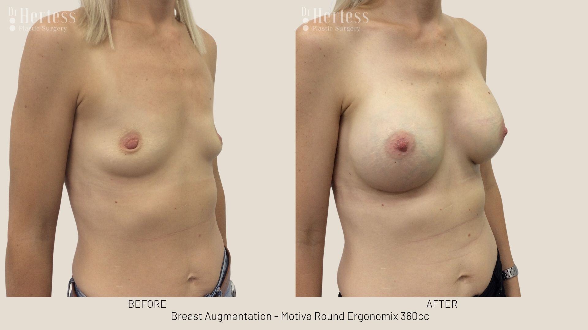 breast implant photos before and after