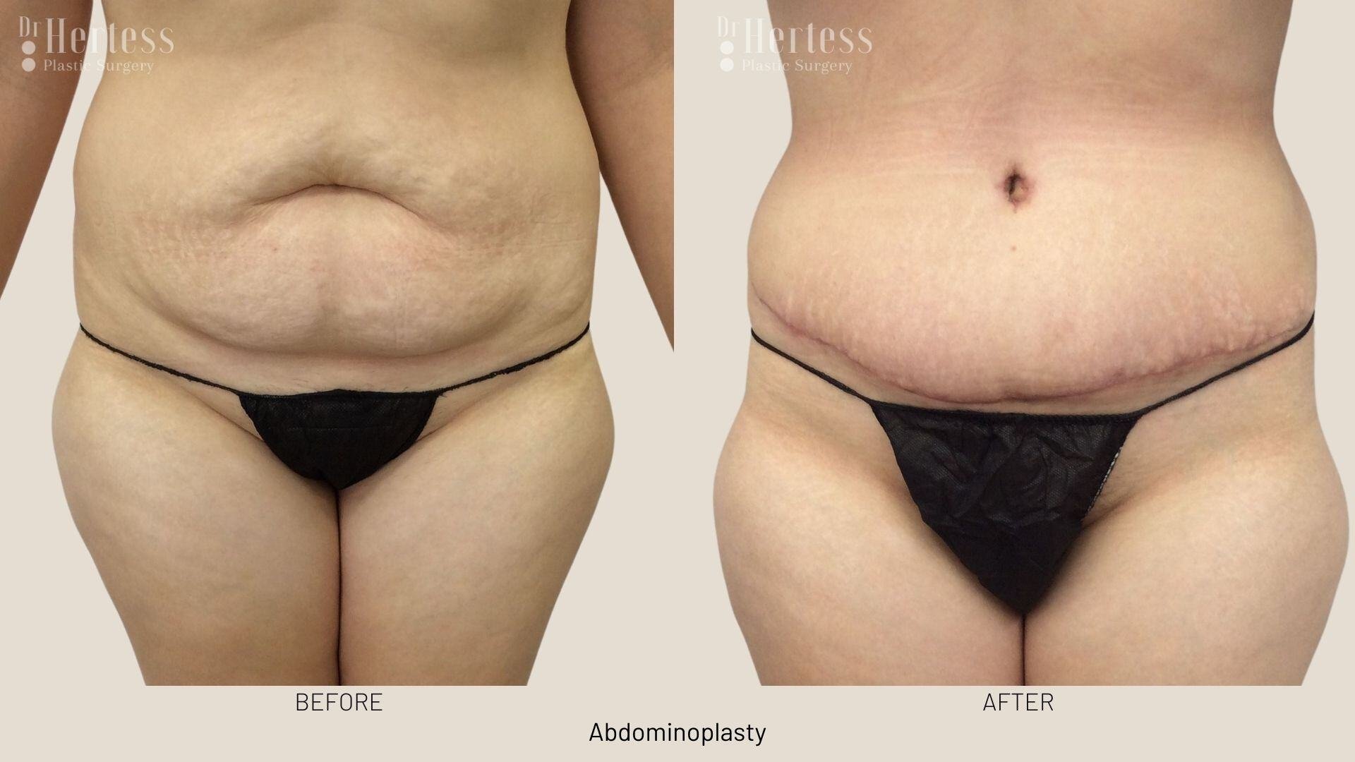 tummy tuck before and after
