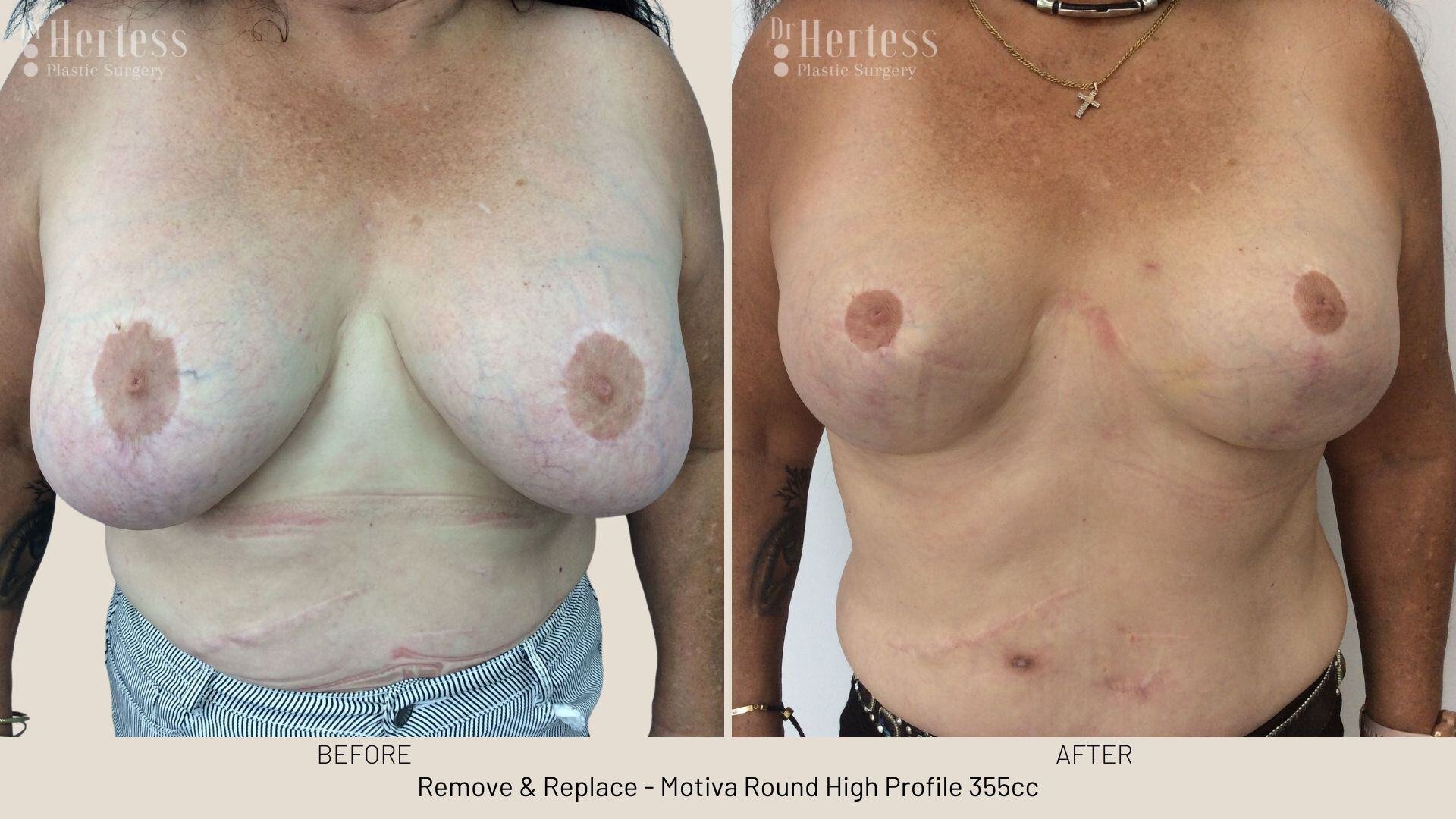 remove replace breast implants photos