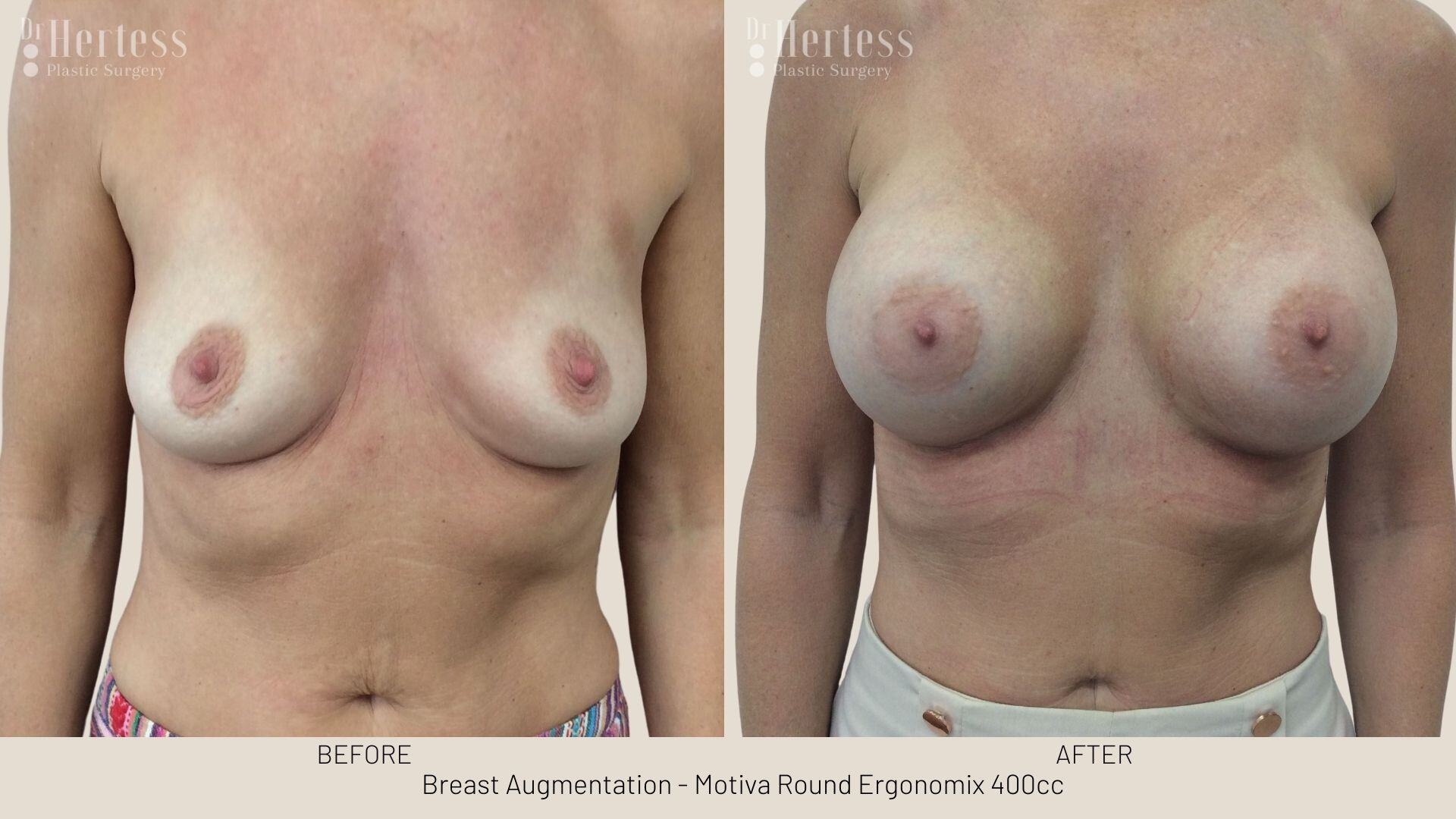 breast implant photos before and after