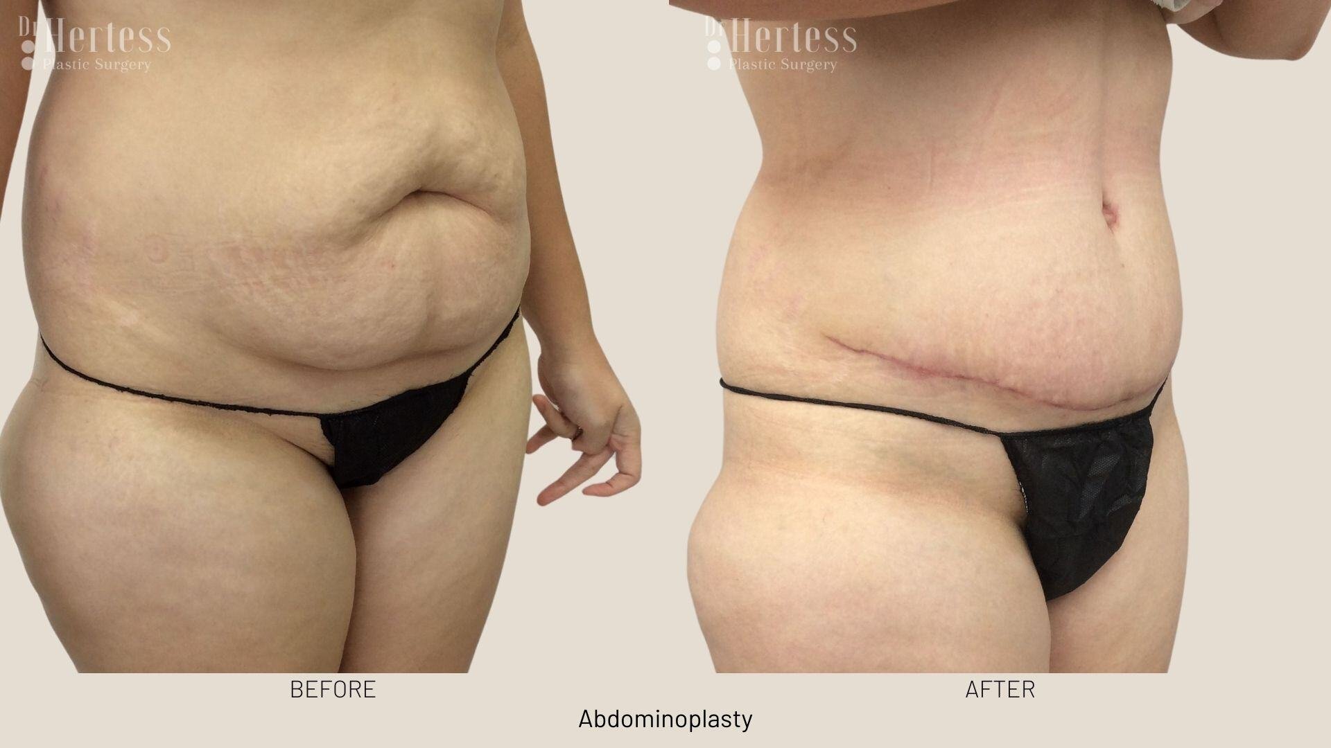 tummy tuck before and after
