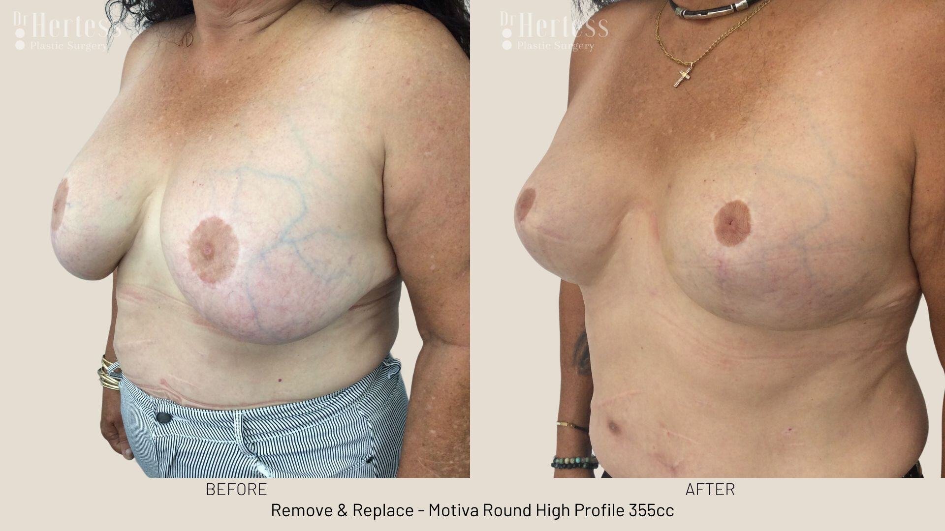remove replace breast implants photos
