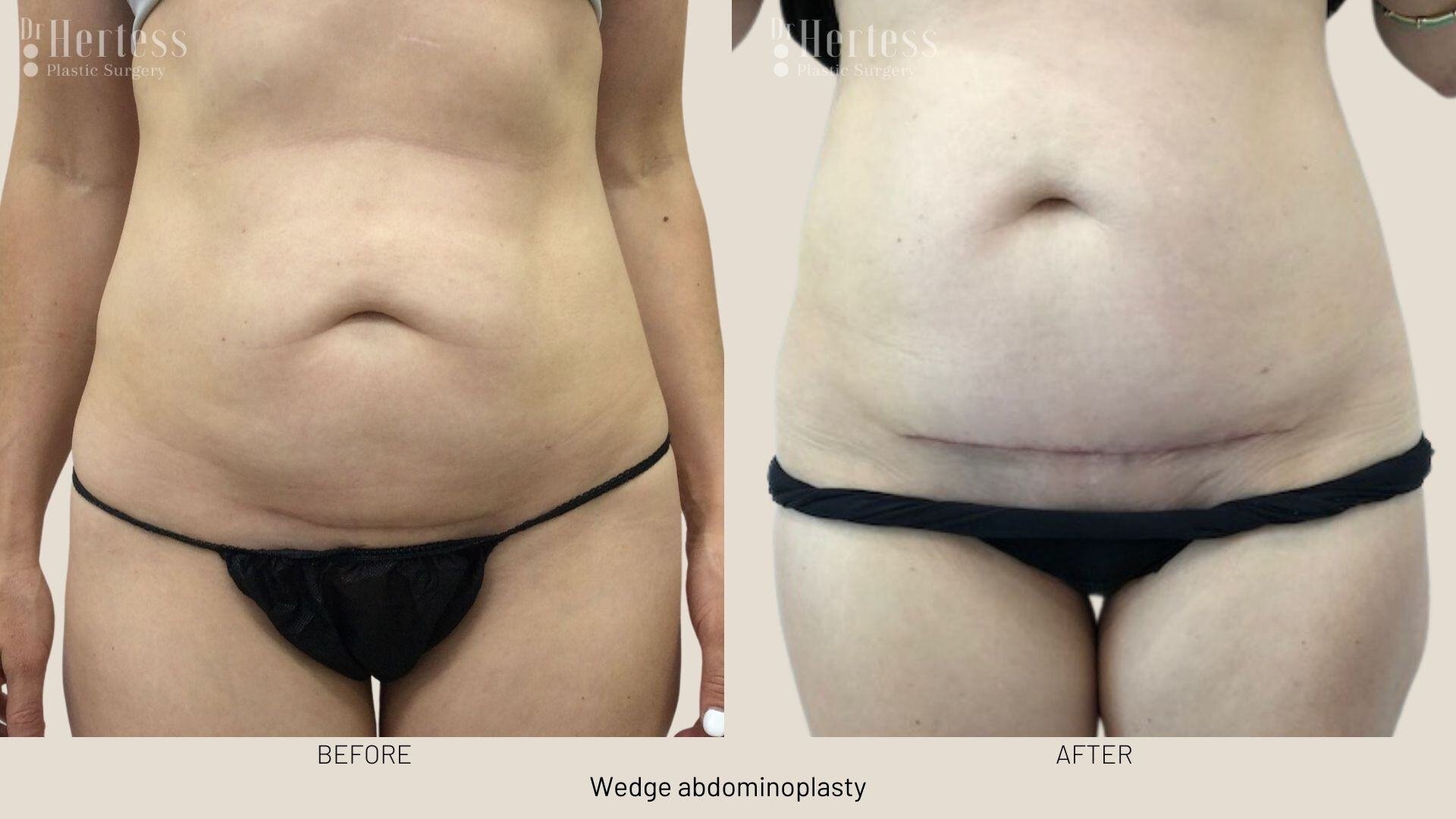 tummy tuck before and after