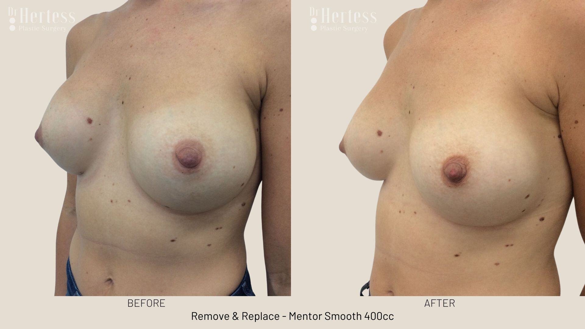 remove replace implants photos