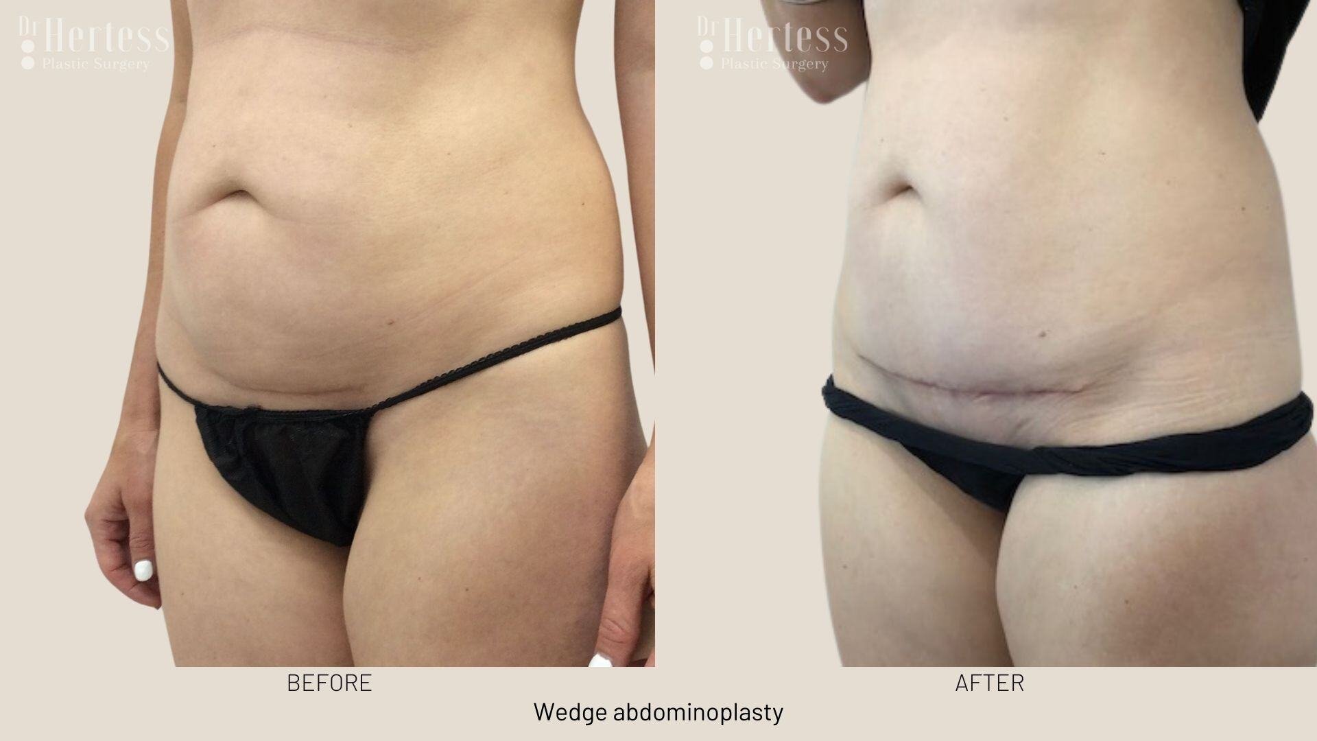tummy tuck before and after