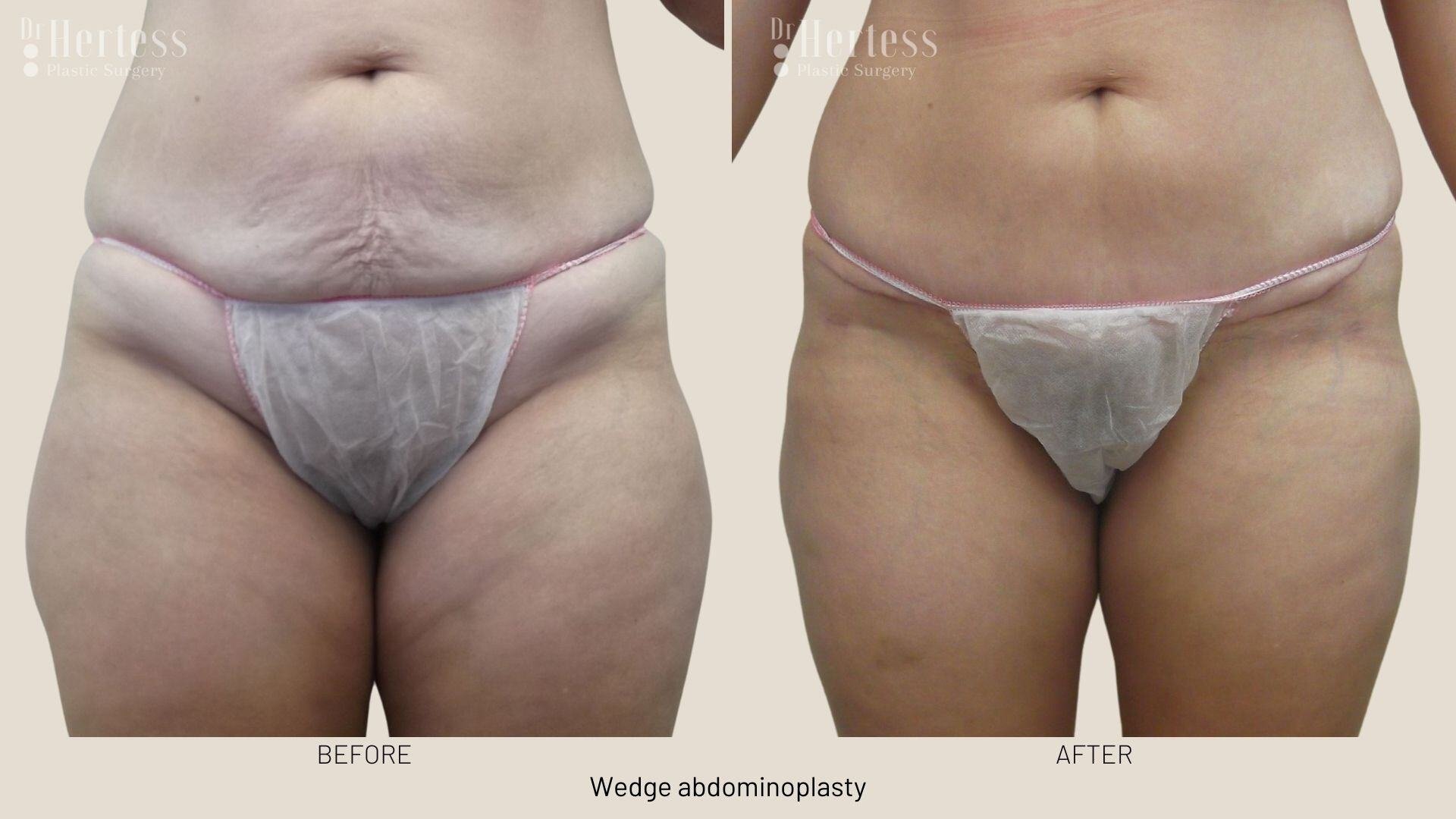 tummy tuck before and after